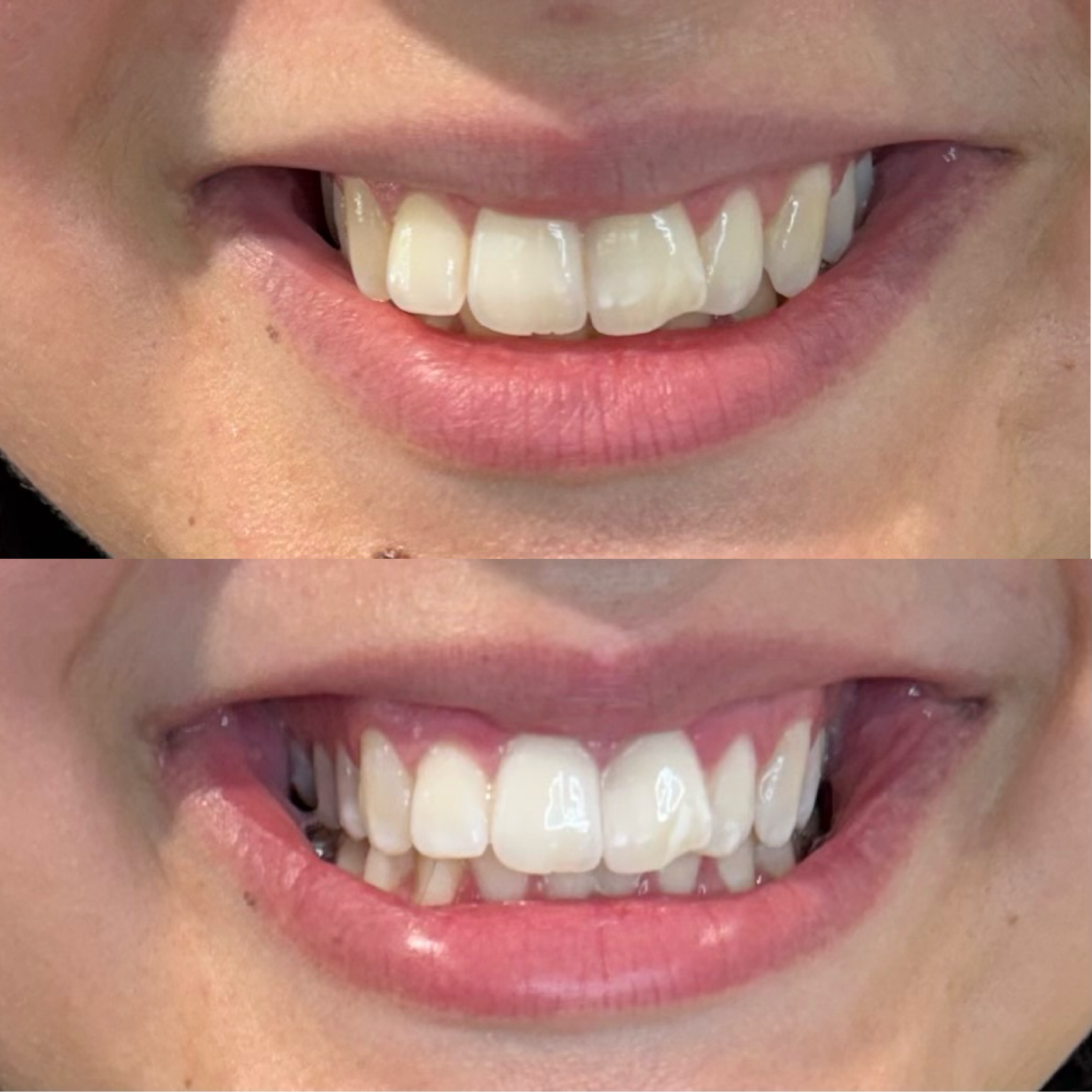 Close-up of a person's mouth showing before and after teeth whitening results, showing improved whiteness and brightness of the teeth in the after image.
