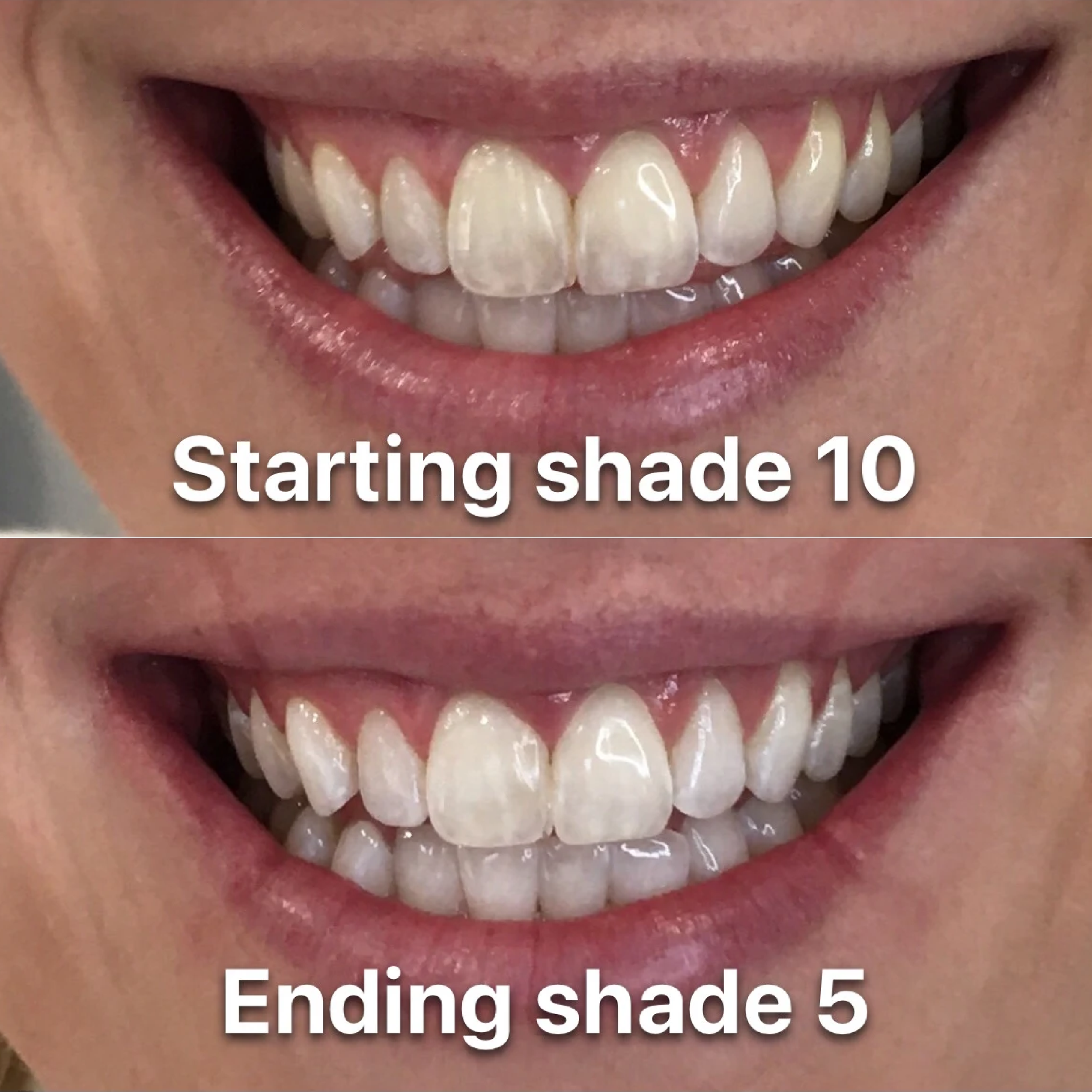 Close-up of a person's mouth showing before and after teeth whitening results, showing improved whiteness and brightness of the teeth in the after image and text overlay showing this person's teeth going from a shade 10 to a shade 5.