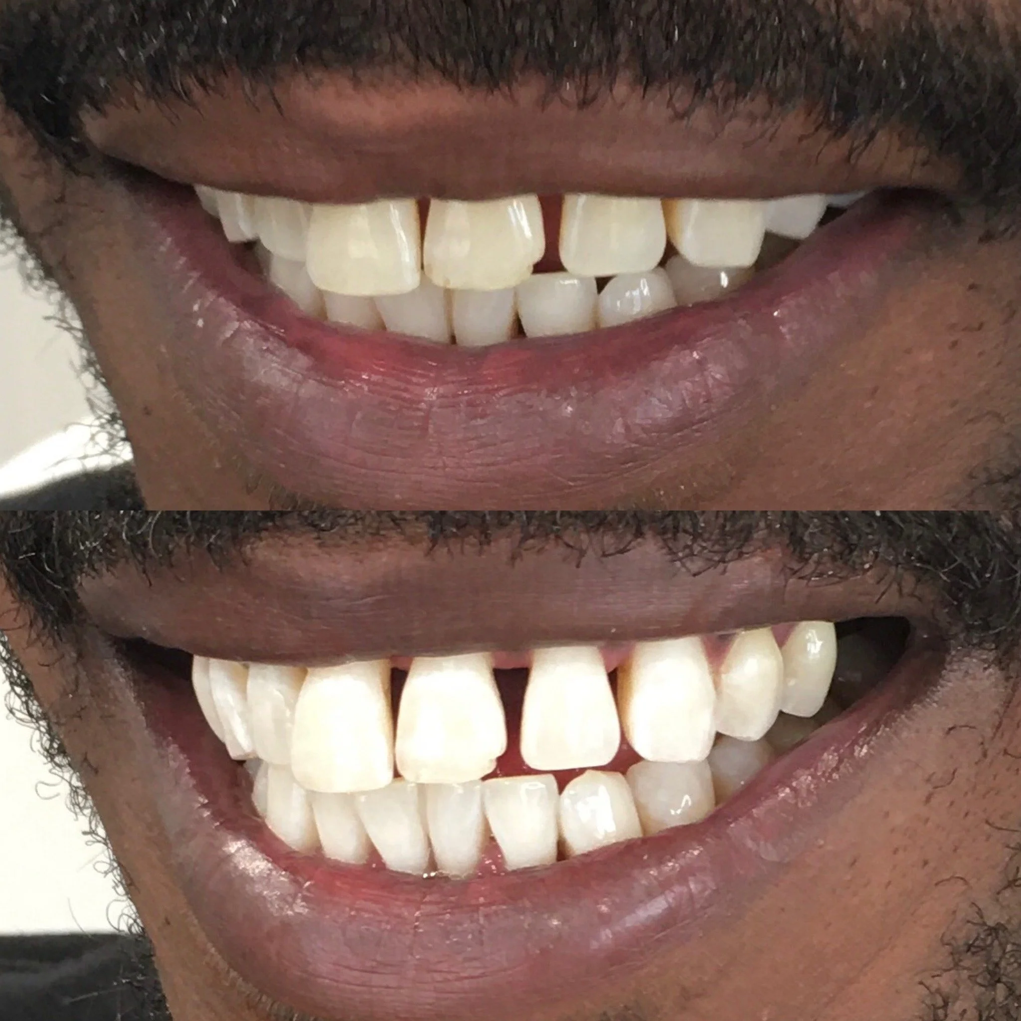Close-up of a person's mouth showing before and after teeth whitening results, showing improved whiteness and brightness of the teeth in the after image.