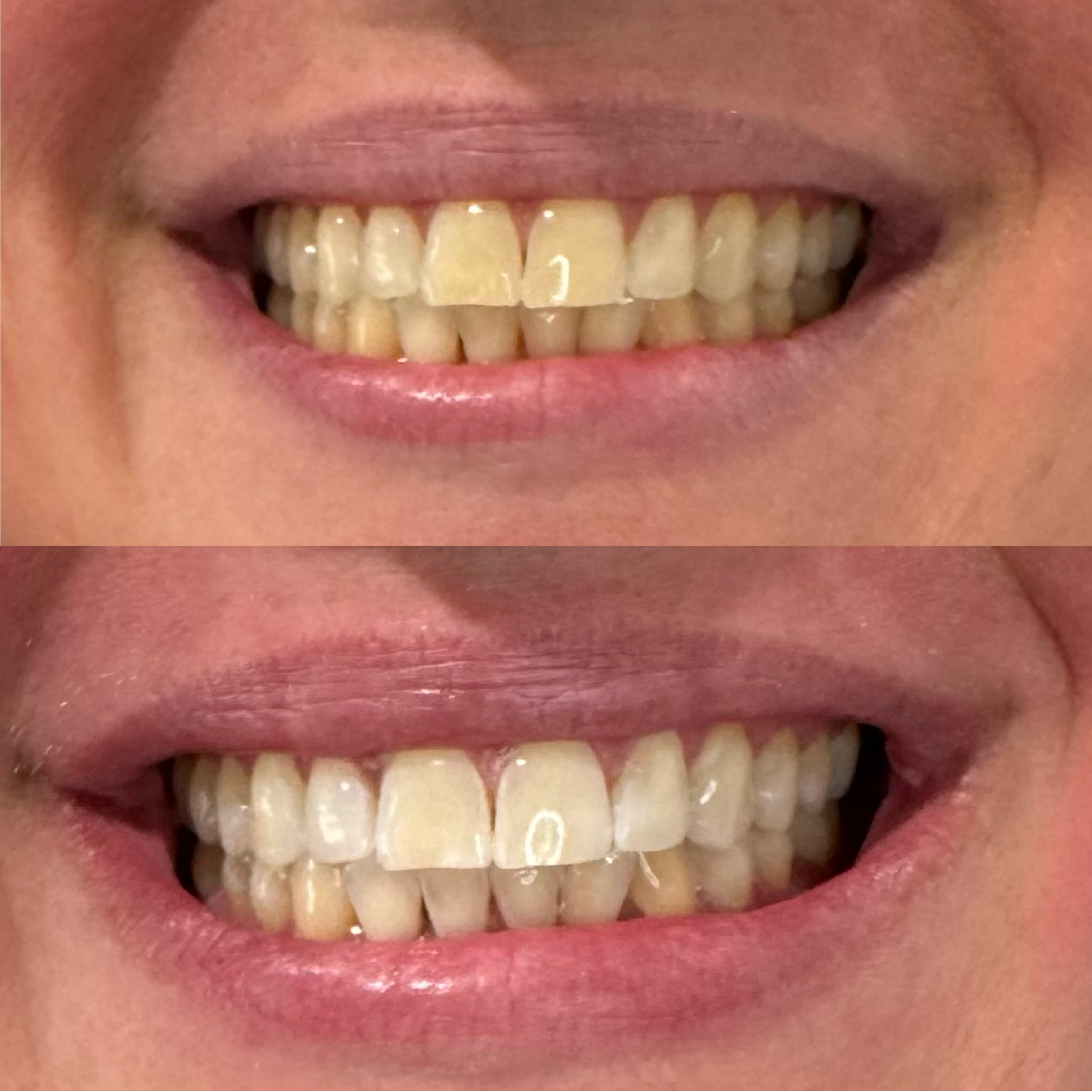 Close-up of a person's mouth showing before and after teeth whitening results, showing improved whiteness and brightness of the teeth in the after image.