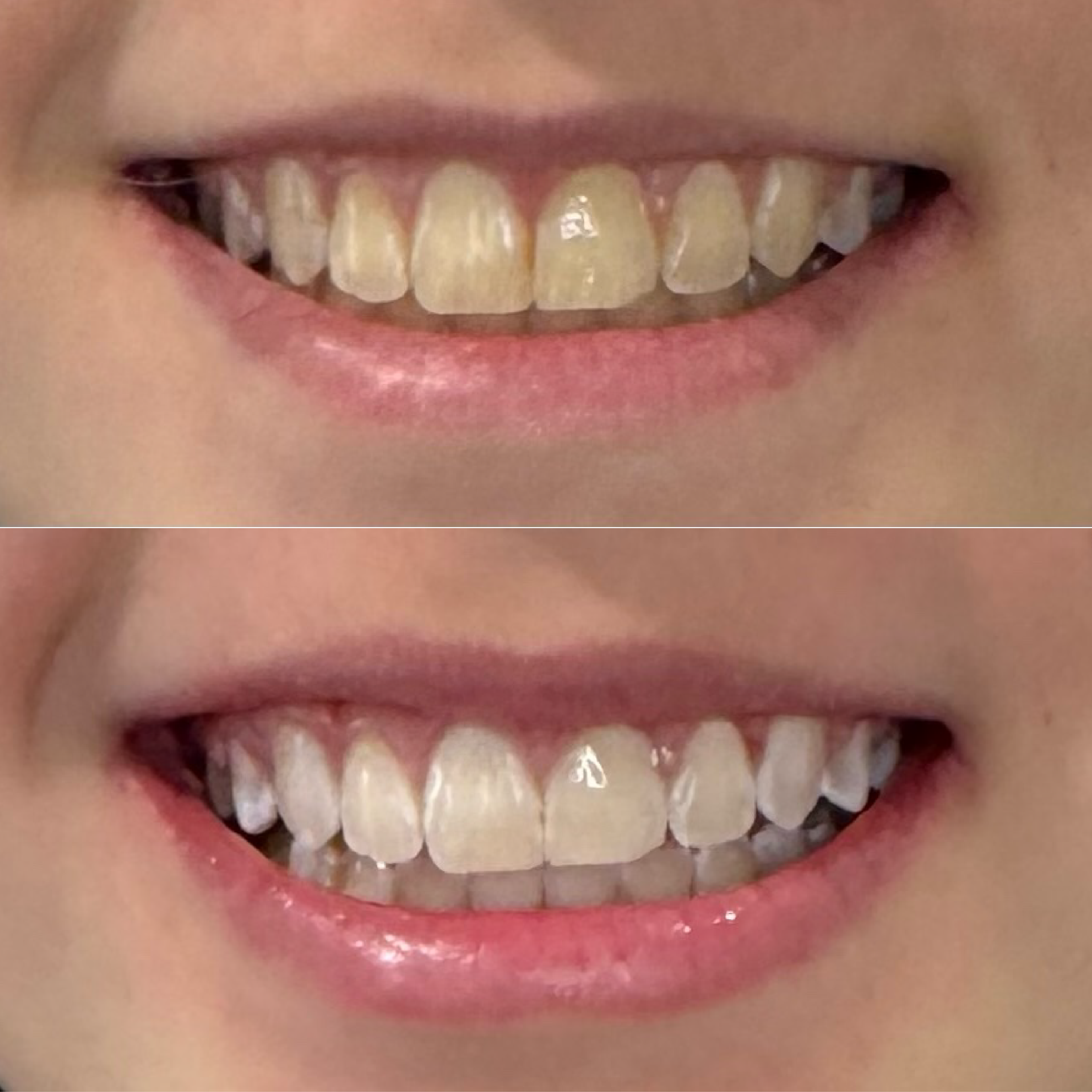 Close-up of a person's mouth showing before and after teeth whitening results, showing improved whiteness and brightness of the teeth in the after image.
