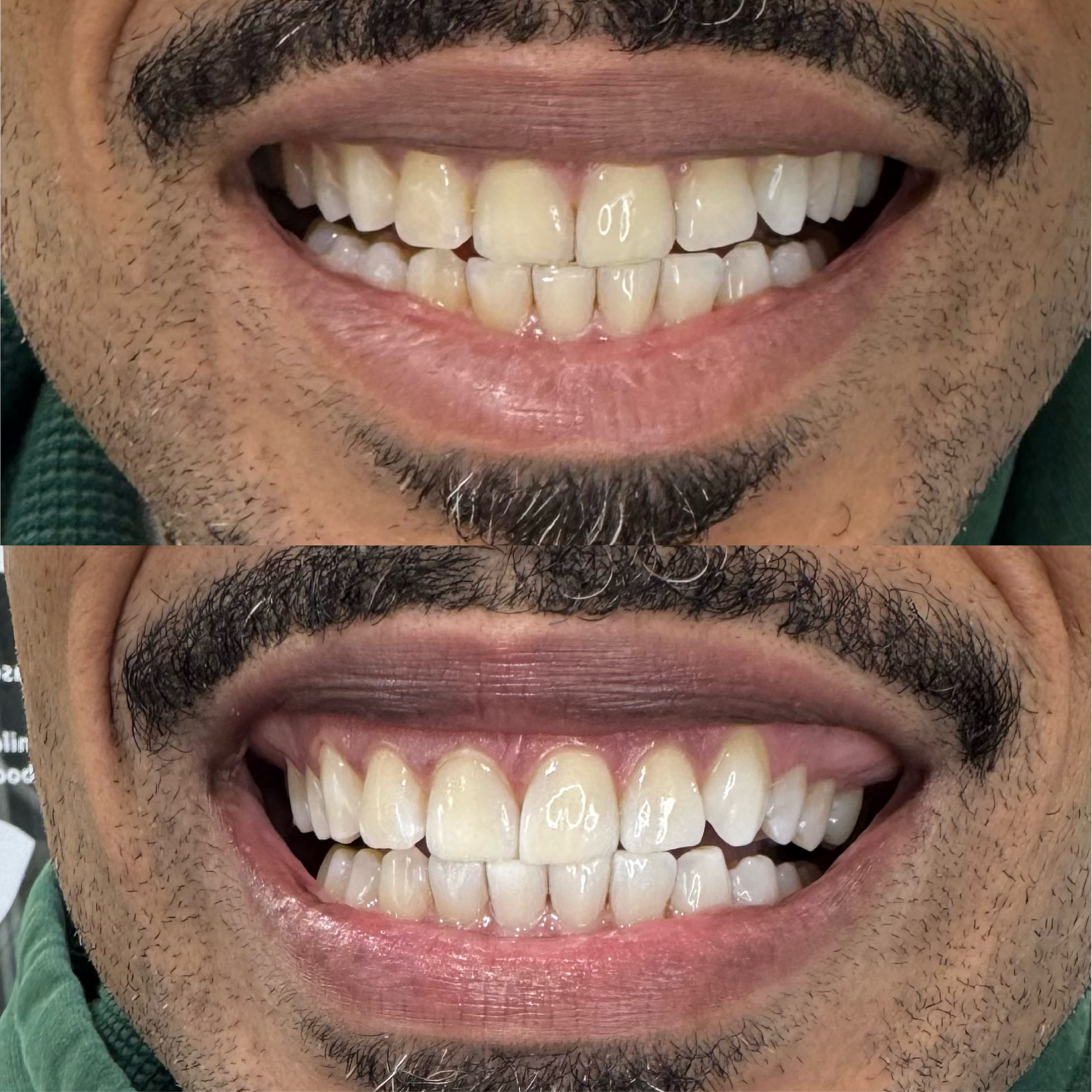 Close-up of a person's mouth showing before and after teeth whitening results, showing improved whiteness and brightness of the teeth in the after image.