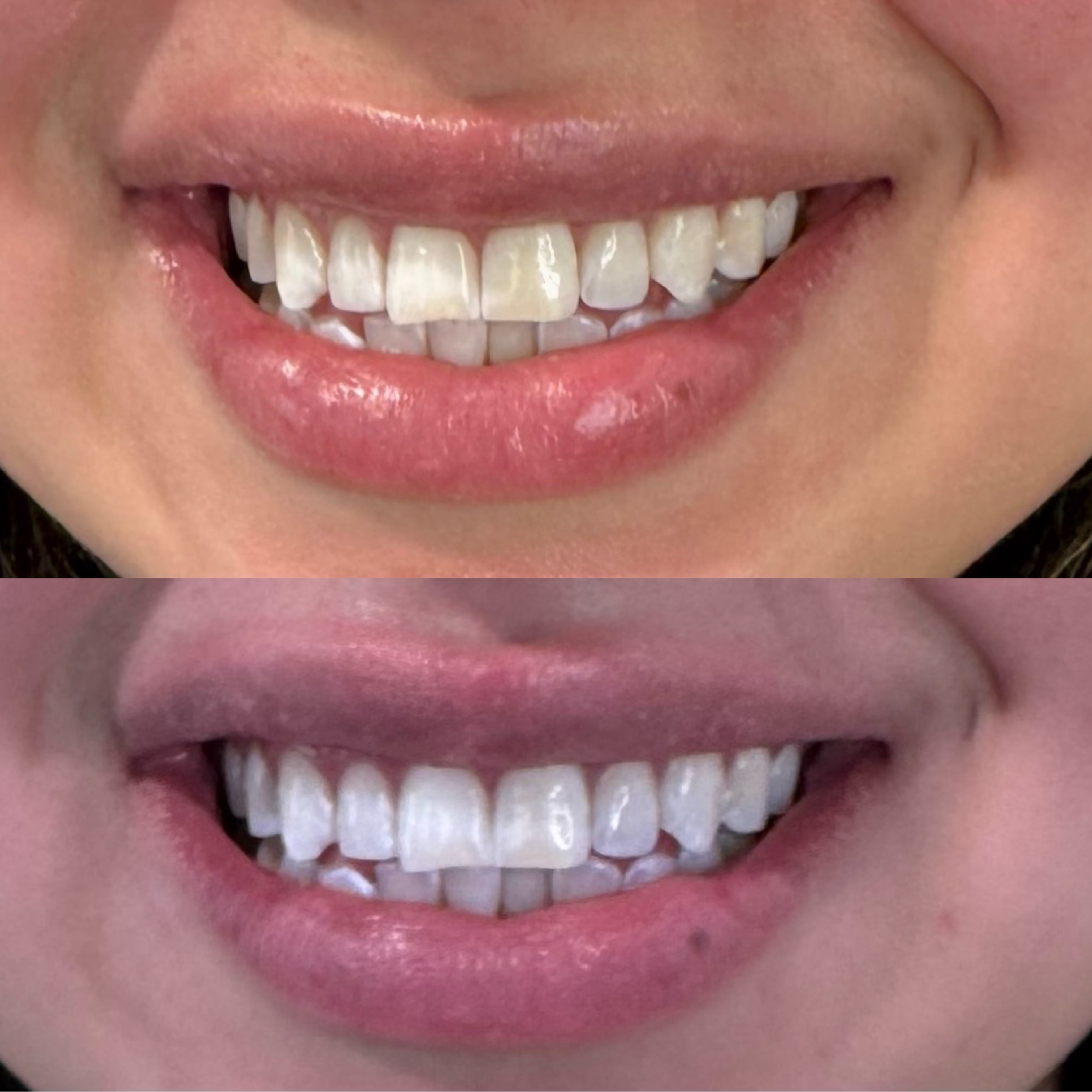 Close-up of a person's mouth showing before and after teeth whitening results, showing improved whiteness and brightness of the teeth in the after image.