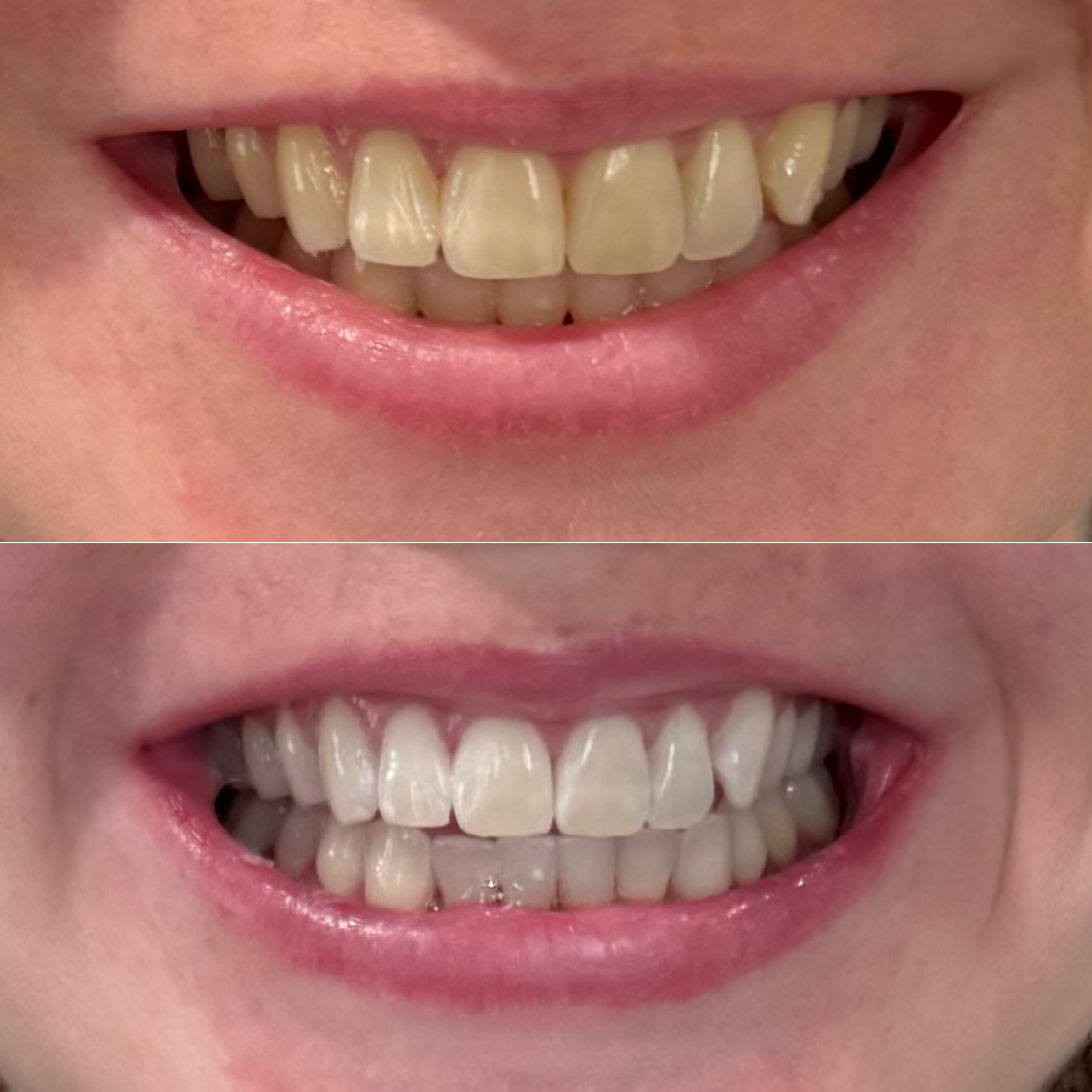Close-up of a person's mouth showing before and after teeth whitening results, showing improved whiteness and brightness of the teeth in the after image.