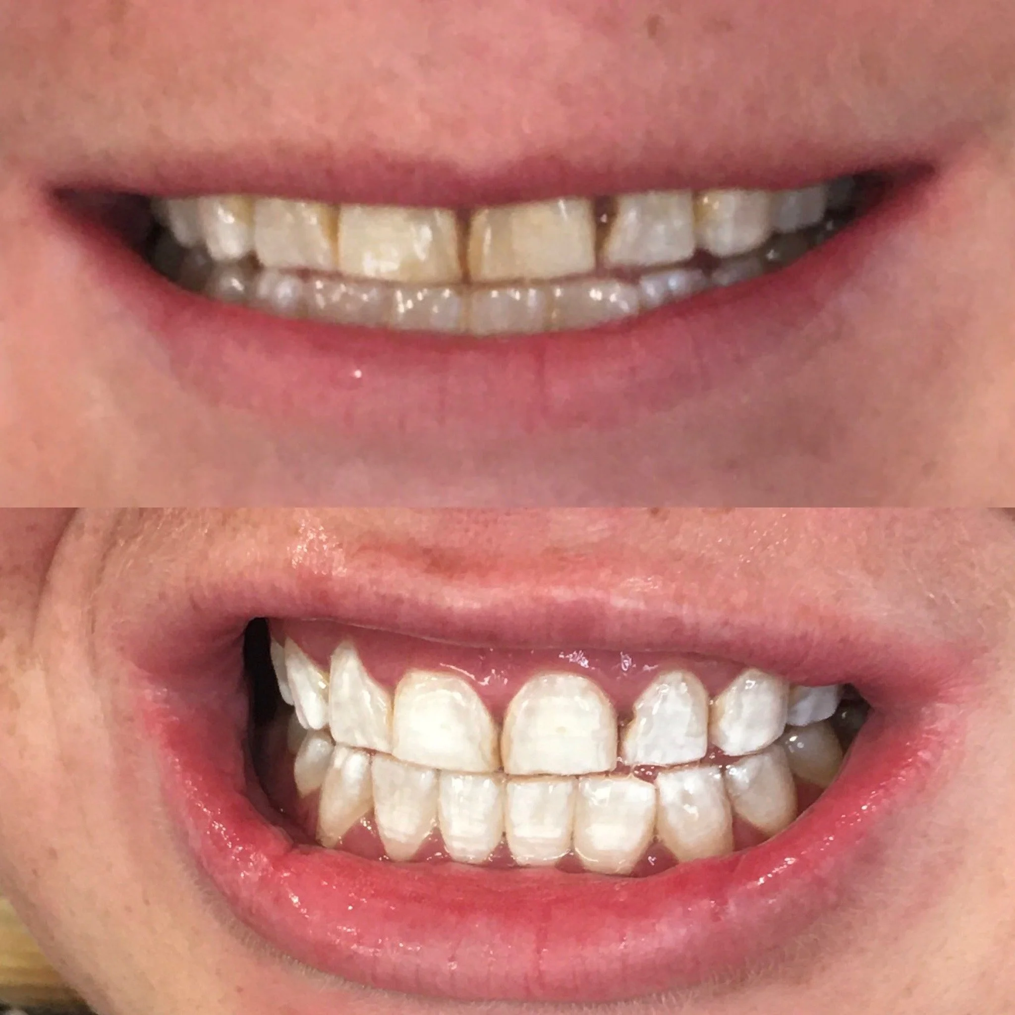 Close-up of a person's mouth showing before and after teeth whitening results, showing improved whiteness and brightness of the teeth in the after image.