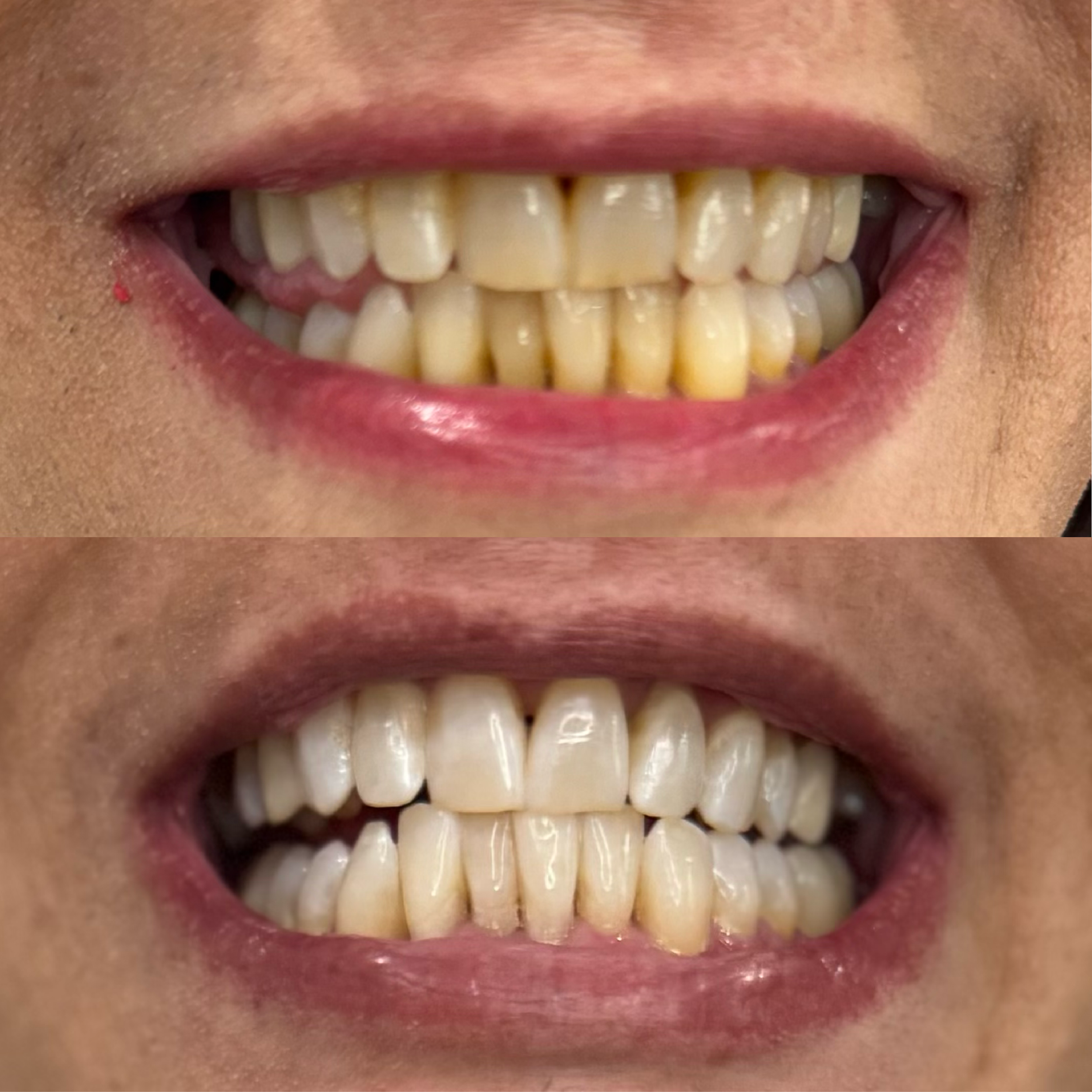 Close-up of a person's mouth showing before and after teeth whitening results, showing improved whiteness and brightness of the teeth in the after image.