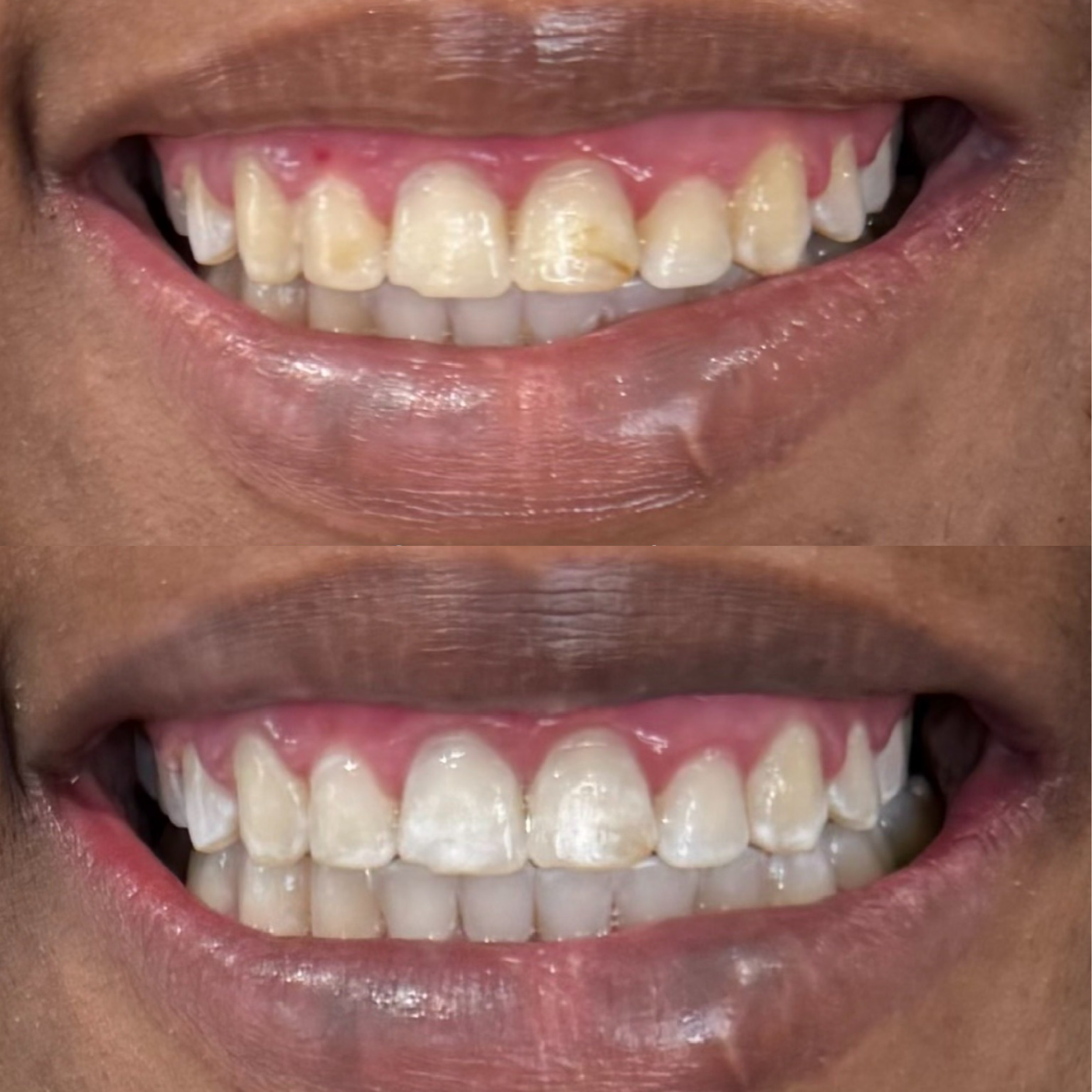 Close-up of a person's mouth showing before and after teeth whitening results, showing improved whiteness and brightness of the teeth in the after image.