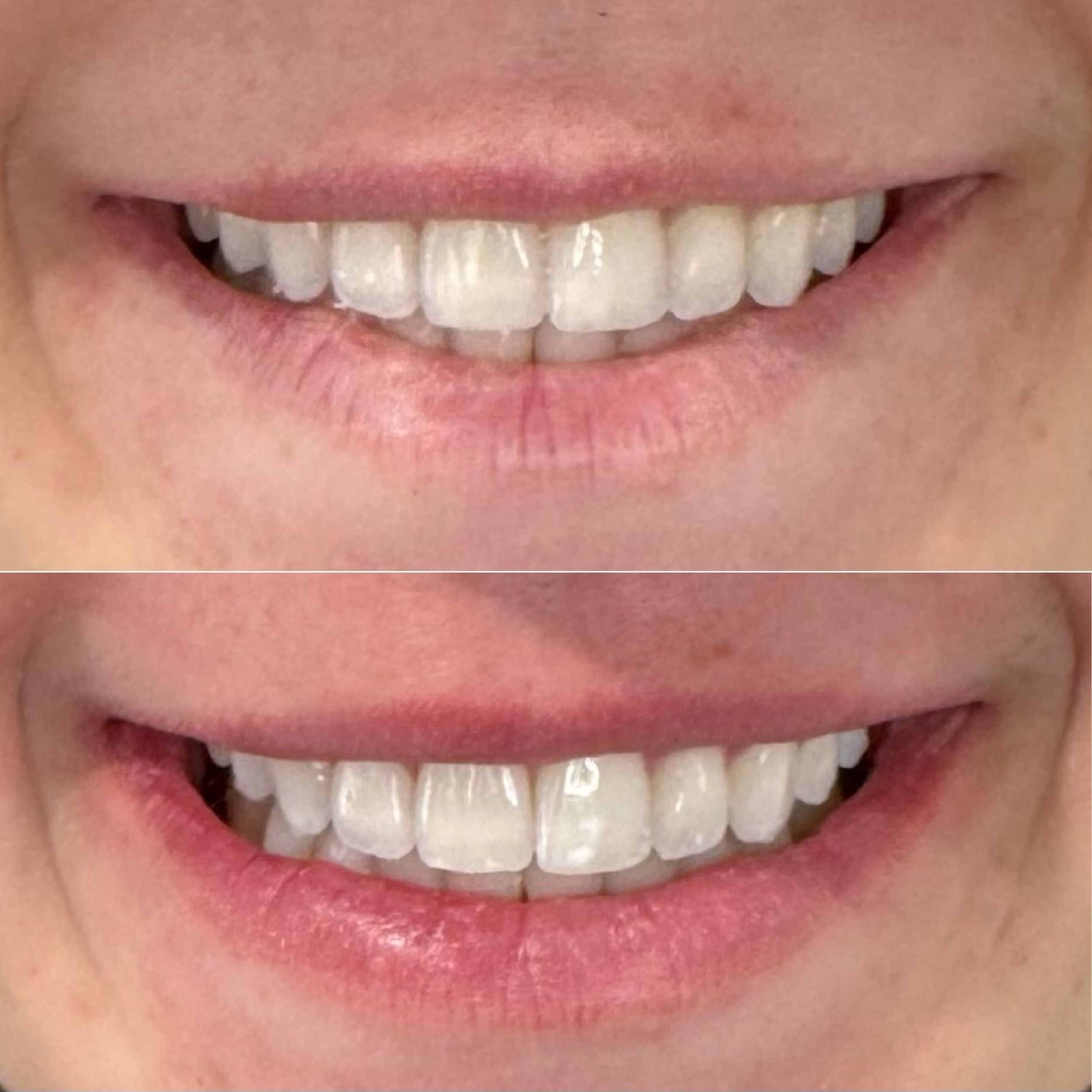 Close-up of a person's mouth showing before and after teeth whitening results, showing improved whiteness and brightness of the teeth in the after image.