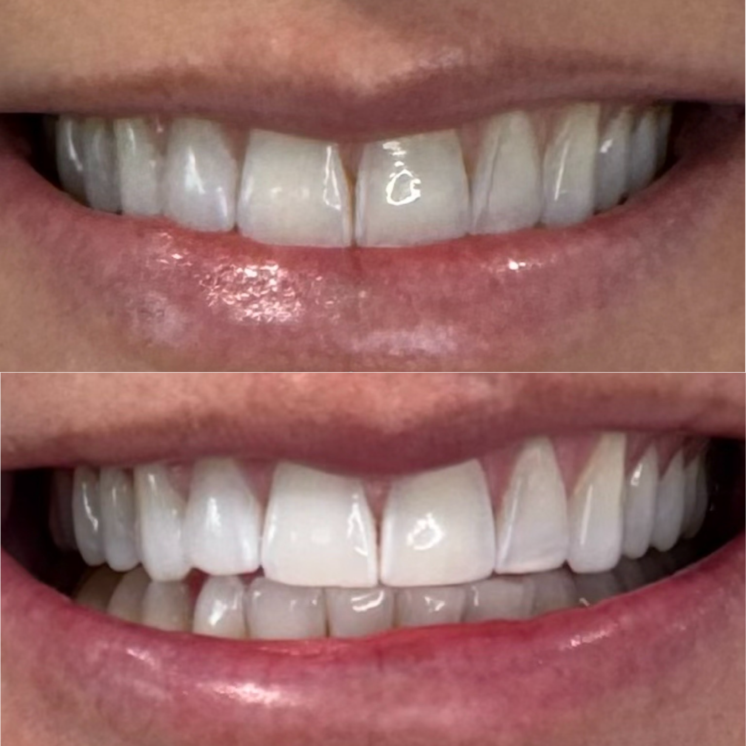 Close-up of a person's mouth showing before and after teeth whitening results, showing improved whiteness and brightness of the teeth in the after image.