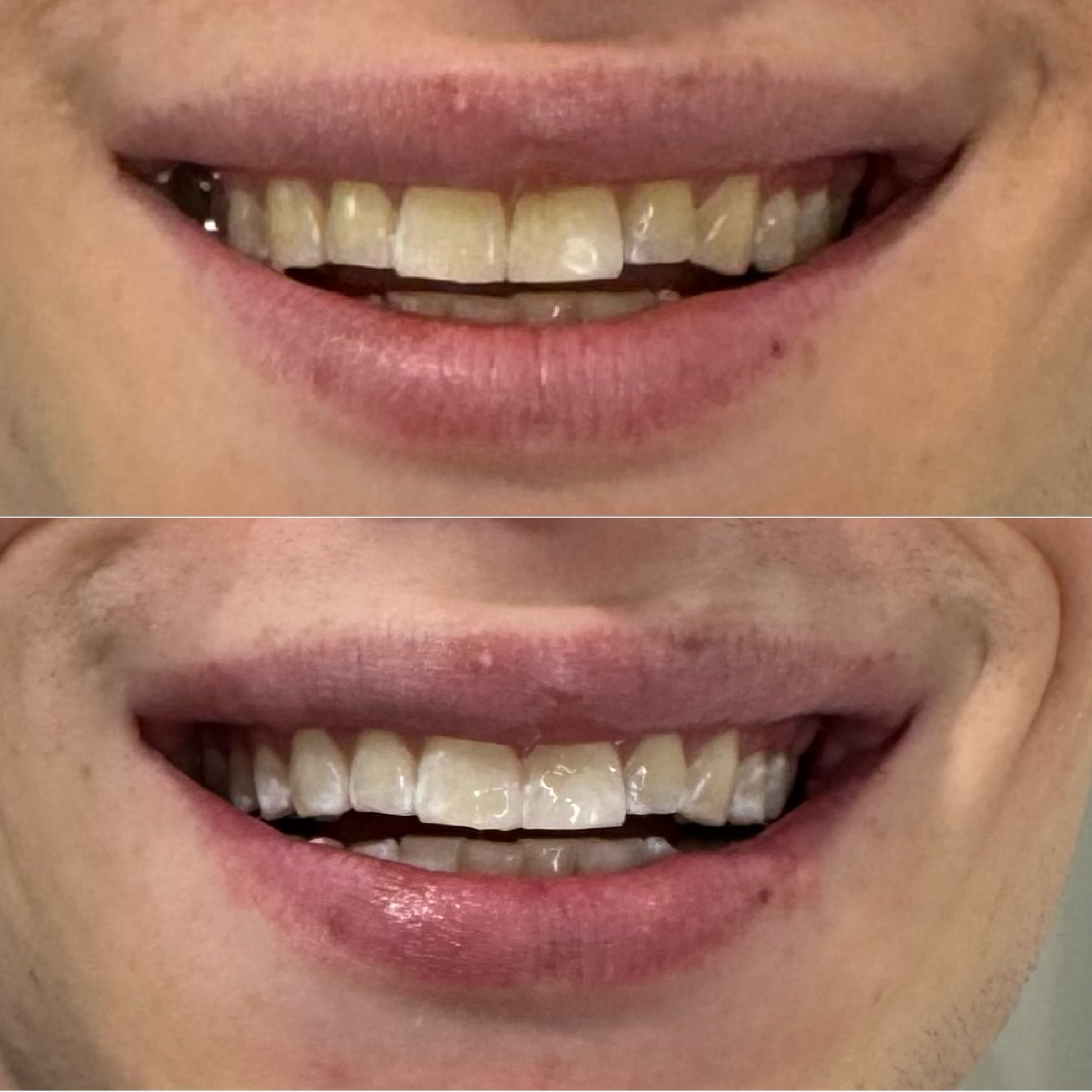 Close-up of a person's mouth showing before and after teeth whitening results, showing improved whiteness and brightness of the teeth in the after image.