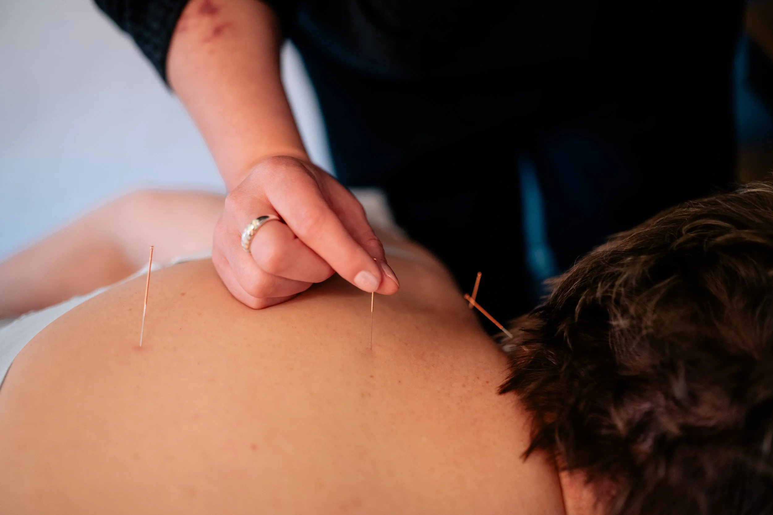 Acupuncture &amp; Nervous System Regulation: How Acupuncture Can Help Your Body Find Balance