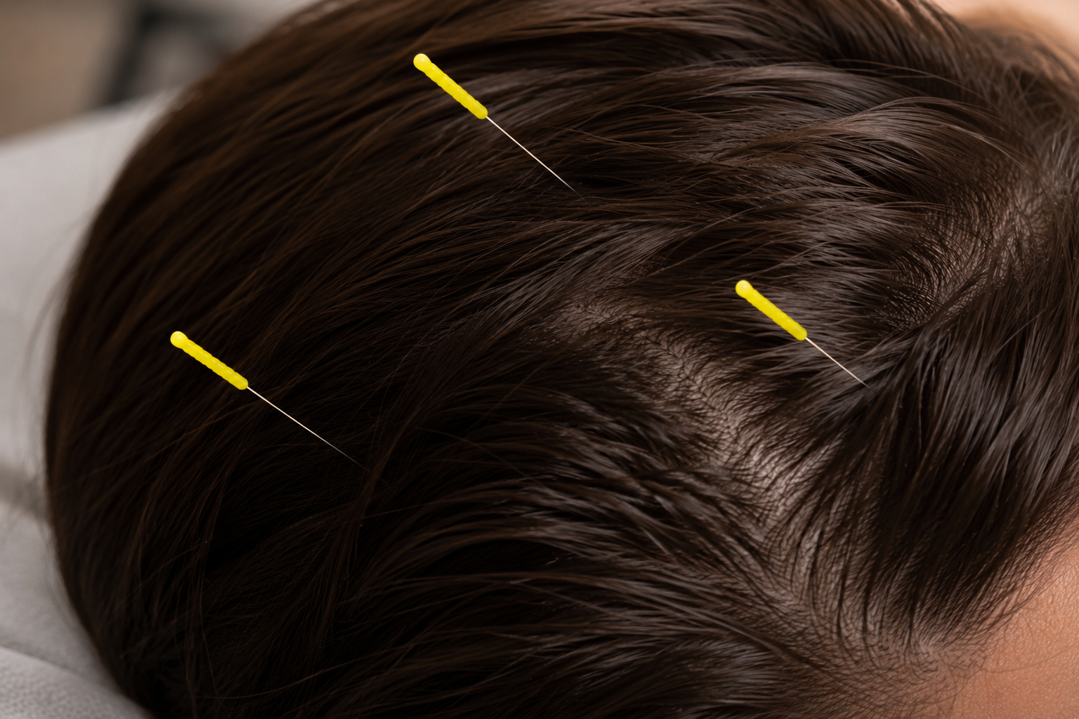Close-up of a person's scalp with three yellow markers indicating areas for acupuncture.