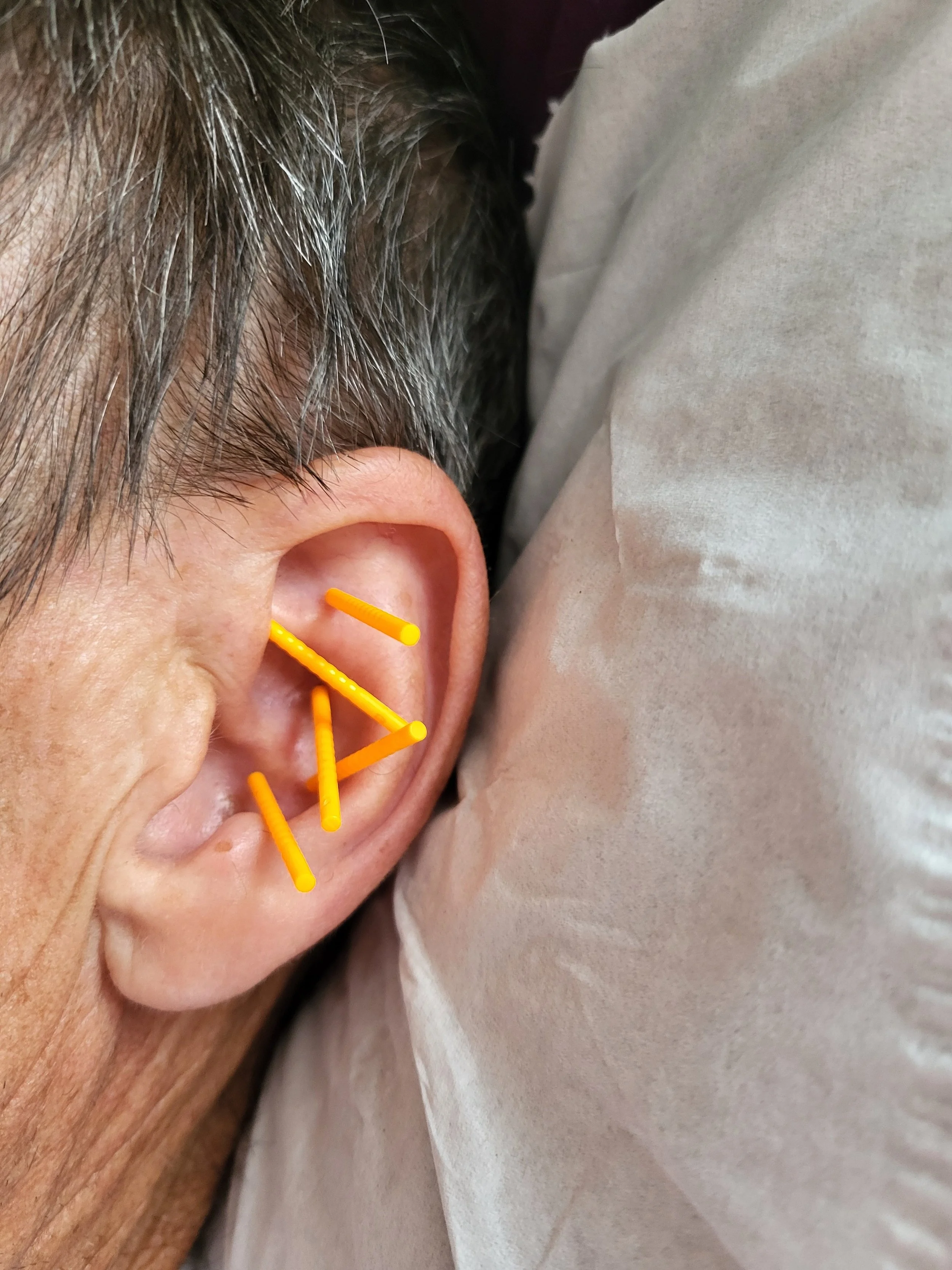 Close-up of a person's ear with several orange acupuncture needles inserted, next to gray hair and a light-colored cloth or sheet.