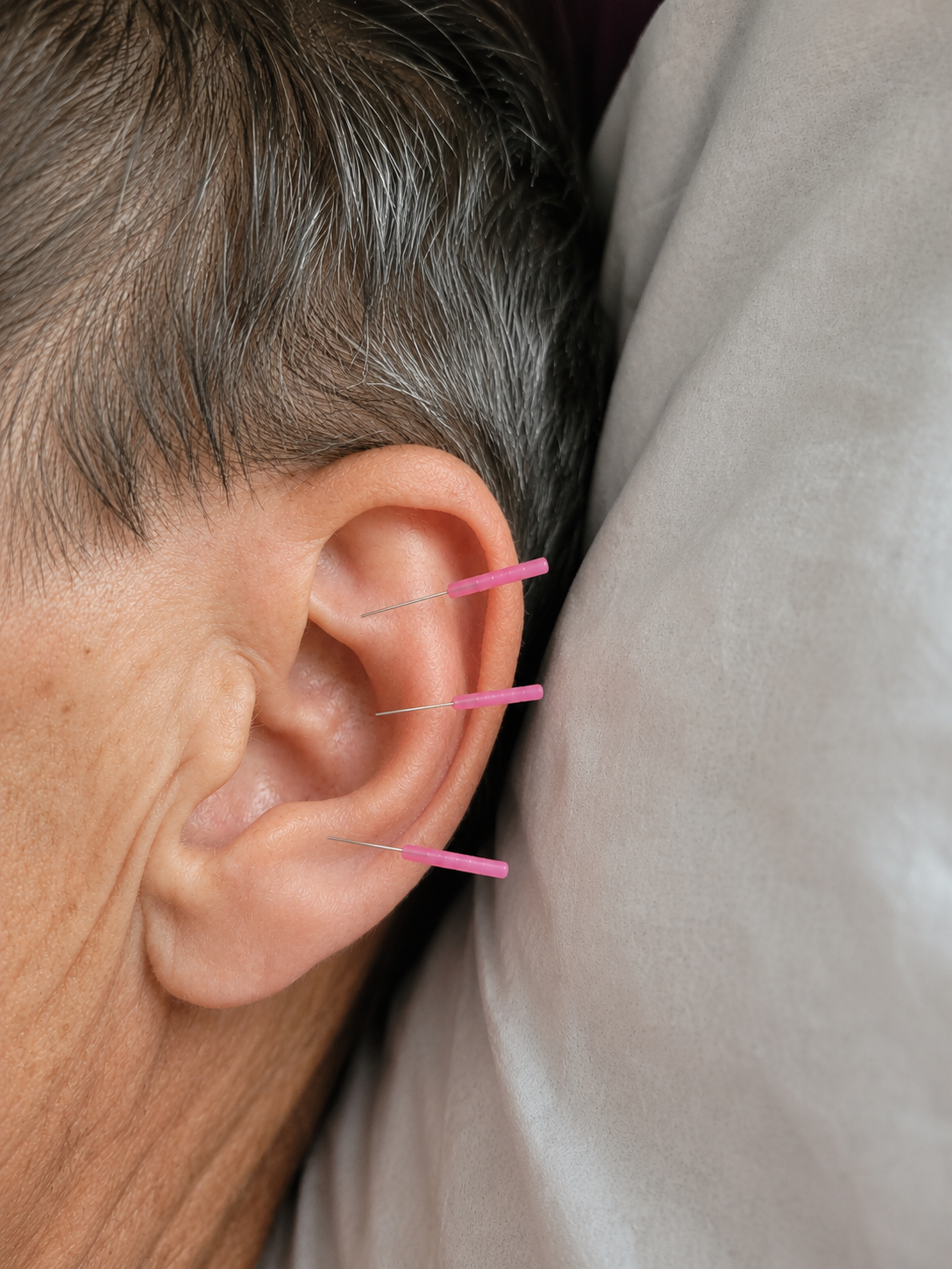 Close-up of a person's ear with three acupuncture needles inserted, resting against a gray fabric surface.