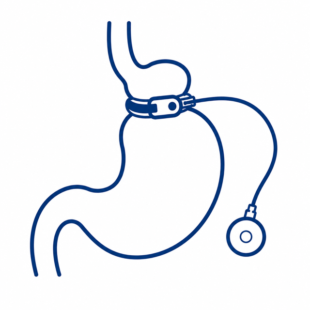 A diagram of a lap band or adjustable gastric band bariatric procedure and removal.