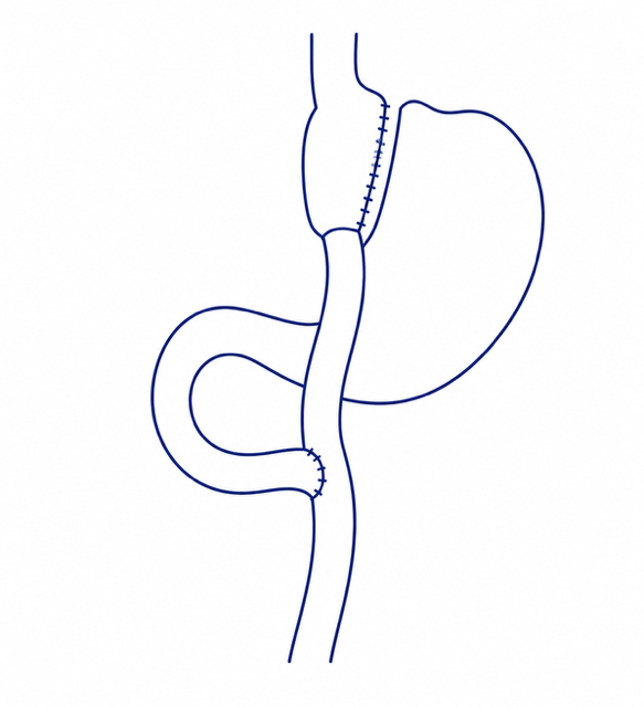 A diagram showing a revisional Roux-en-Y gastric bypass bariatric metabolic surgery.
