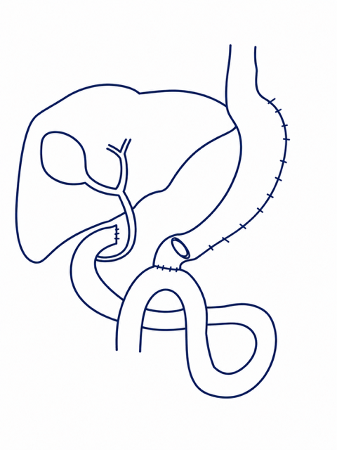 Line drawing illustration of anatomy post single anastomosis duodenal ileal bypass with sleeve gastrectomy (SADI-S).