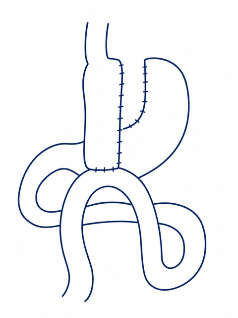 A simple line drawing of a stomach and small bowel after a one anastomosis gastric bypass (OAGB) or 'mini' gastric bypass