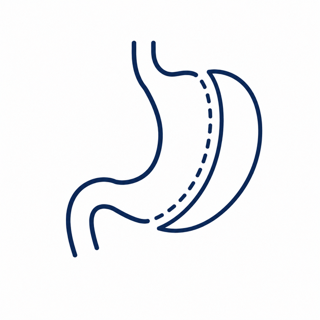 Medical diagram of a stomach with sleeve gastrectomy bariatric metabolic surgery.