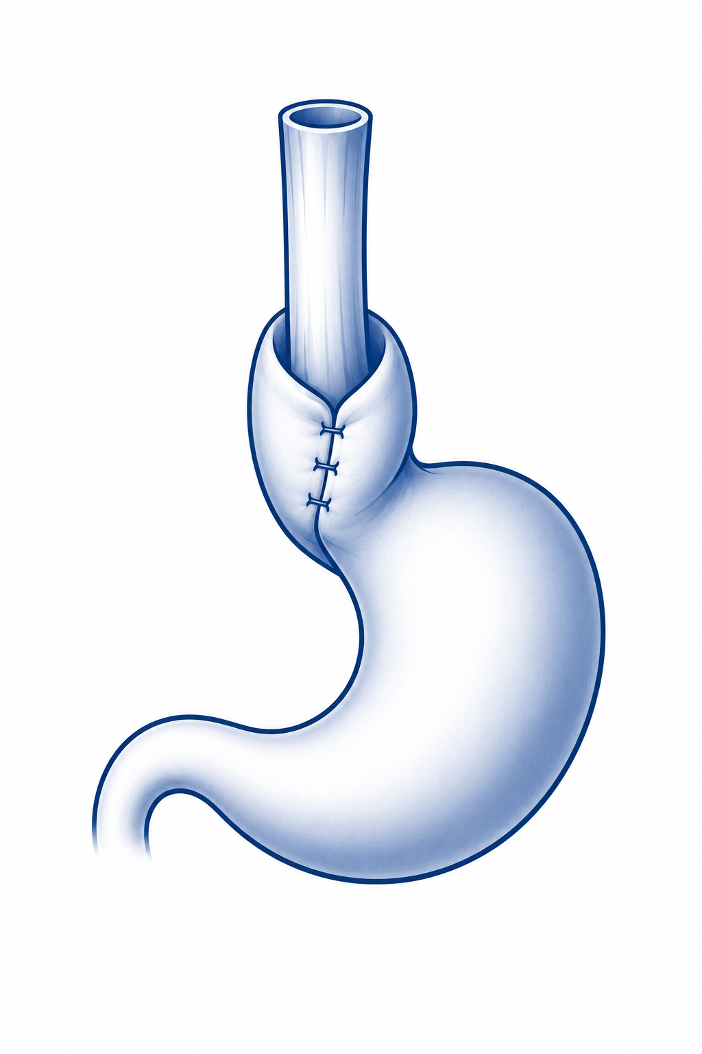 A cartoon illustration of a stomach and oesophagus with a fundoplication wrap.