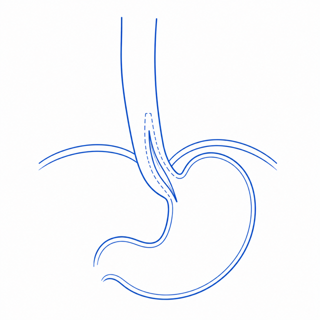 Medical illustration of the human stomach and esophagus showing a Heller myotomy (cardiomyotomy).