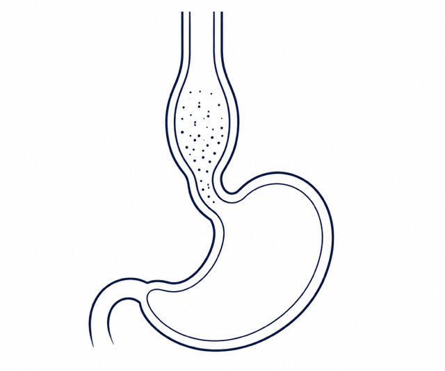 An image of a stomach and dilated oesophagus depicting achalasia
