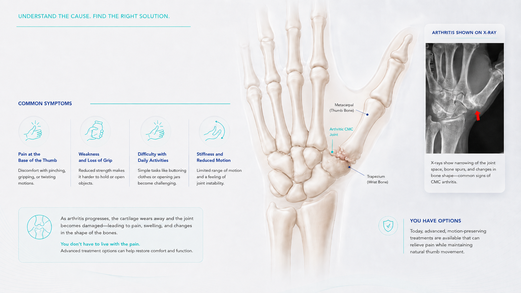 An infographic about arthritis in the thumb, showing an anatomical illustration of a hand with labeled bones and joints. A section on the right displays an X-ray image highlighting joint narrowing and bone spurs, indicating CMC arthritis. The infographic includes text about symptoms and treatment options for arthritis.