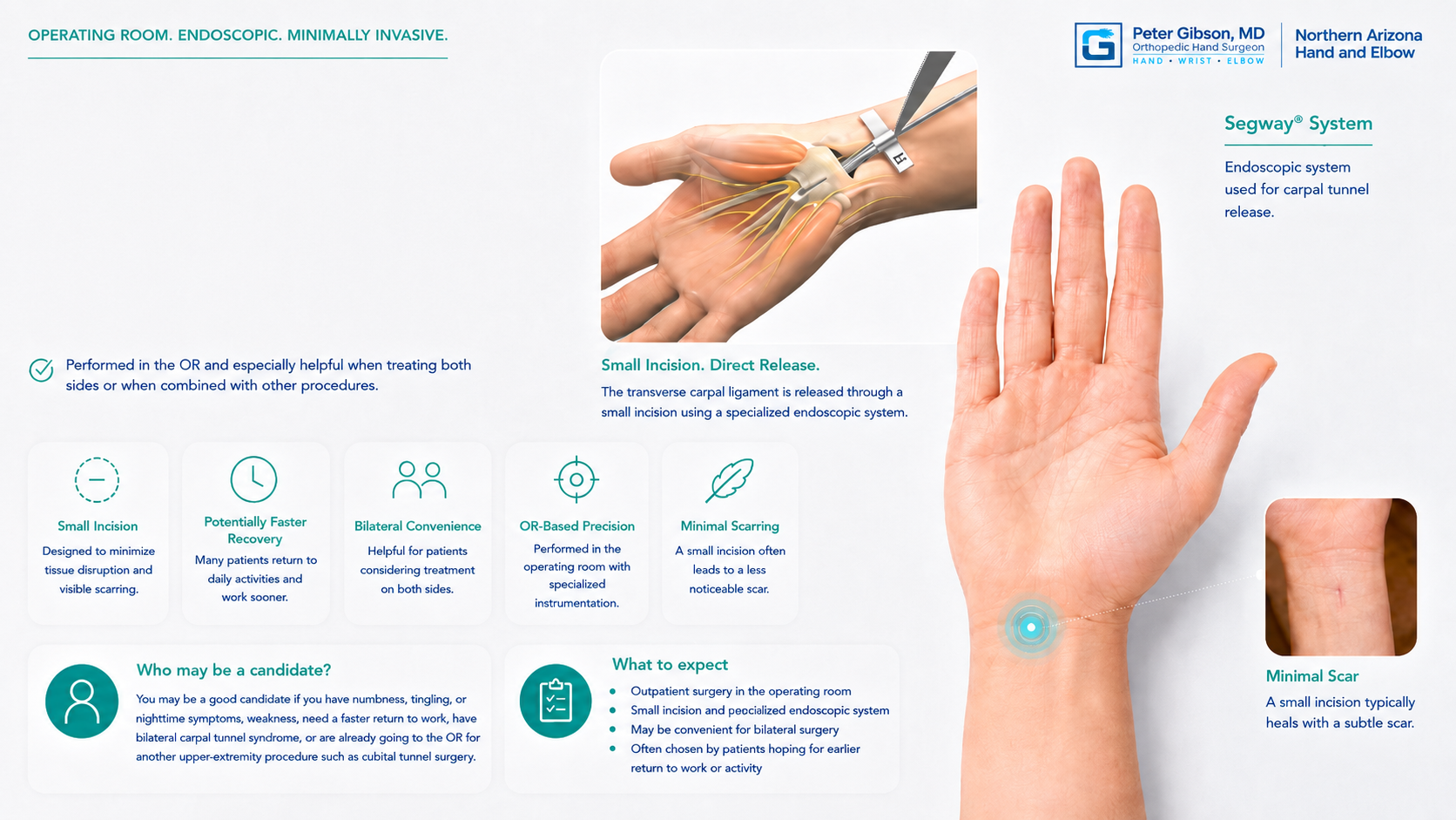 An infographic about the Segway System for carpal tunnel release, showing a small incision on a hand with a close-up view of the scar, and a diagram of the endoscopic procedure. It includes information about the procedure's benefits and candidate criteria.