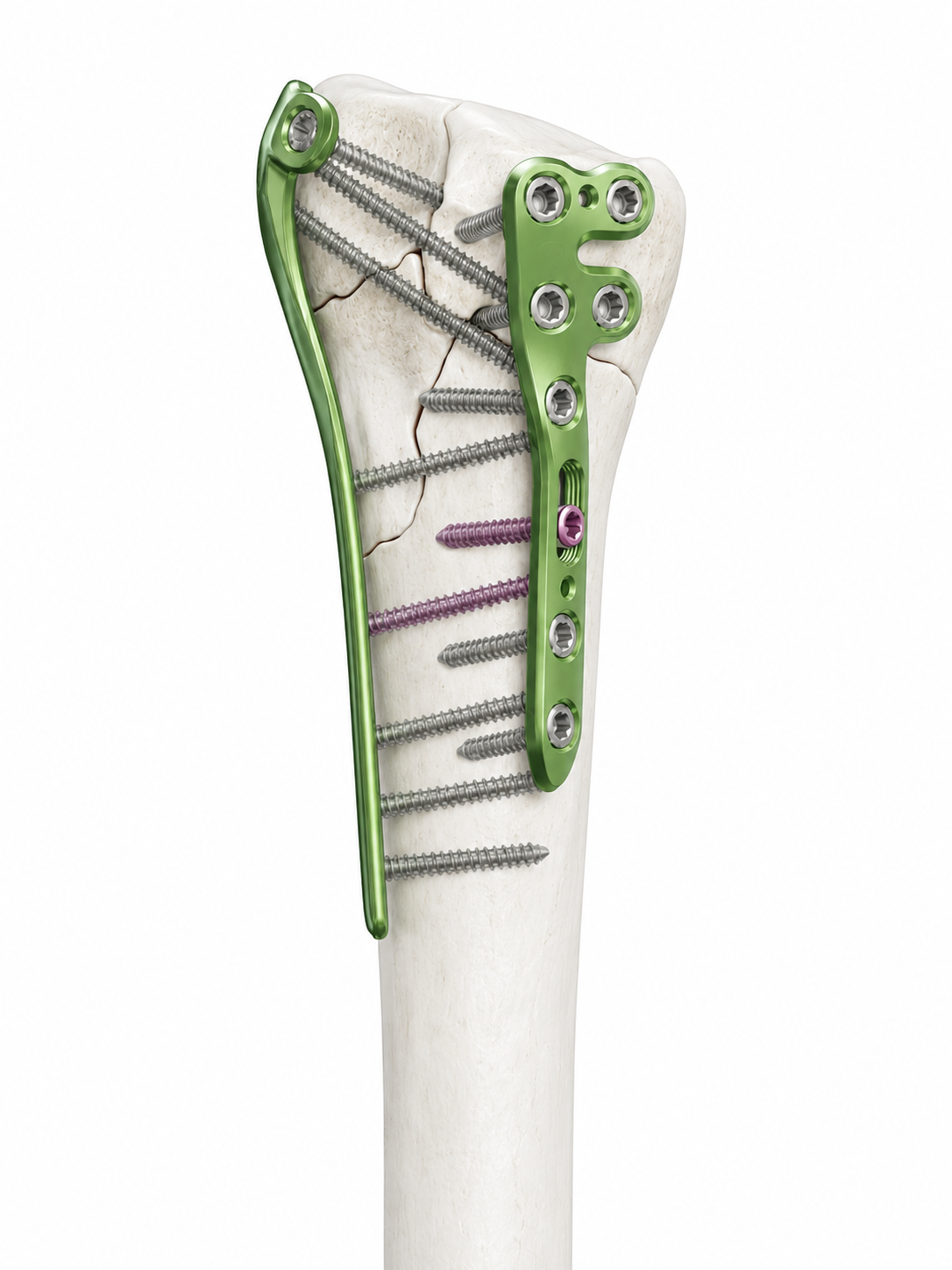 Distal radius implant example