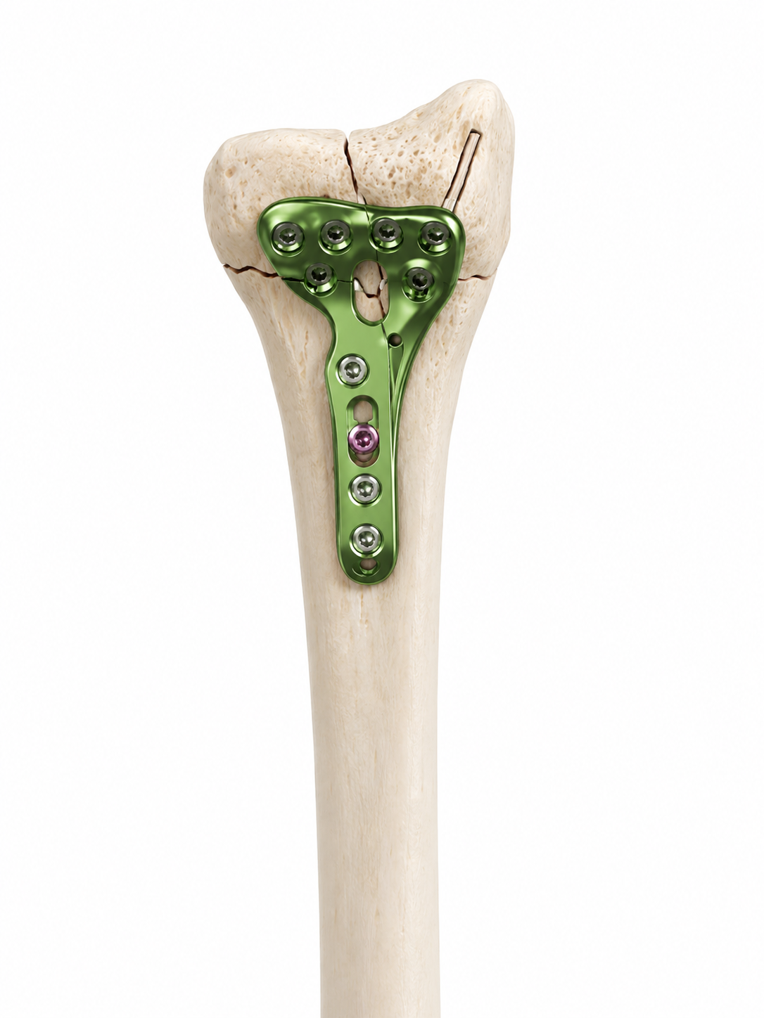 Distal radius implant example