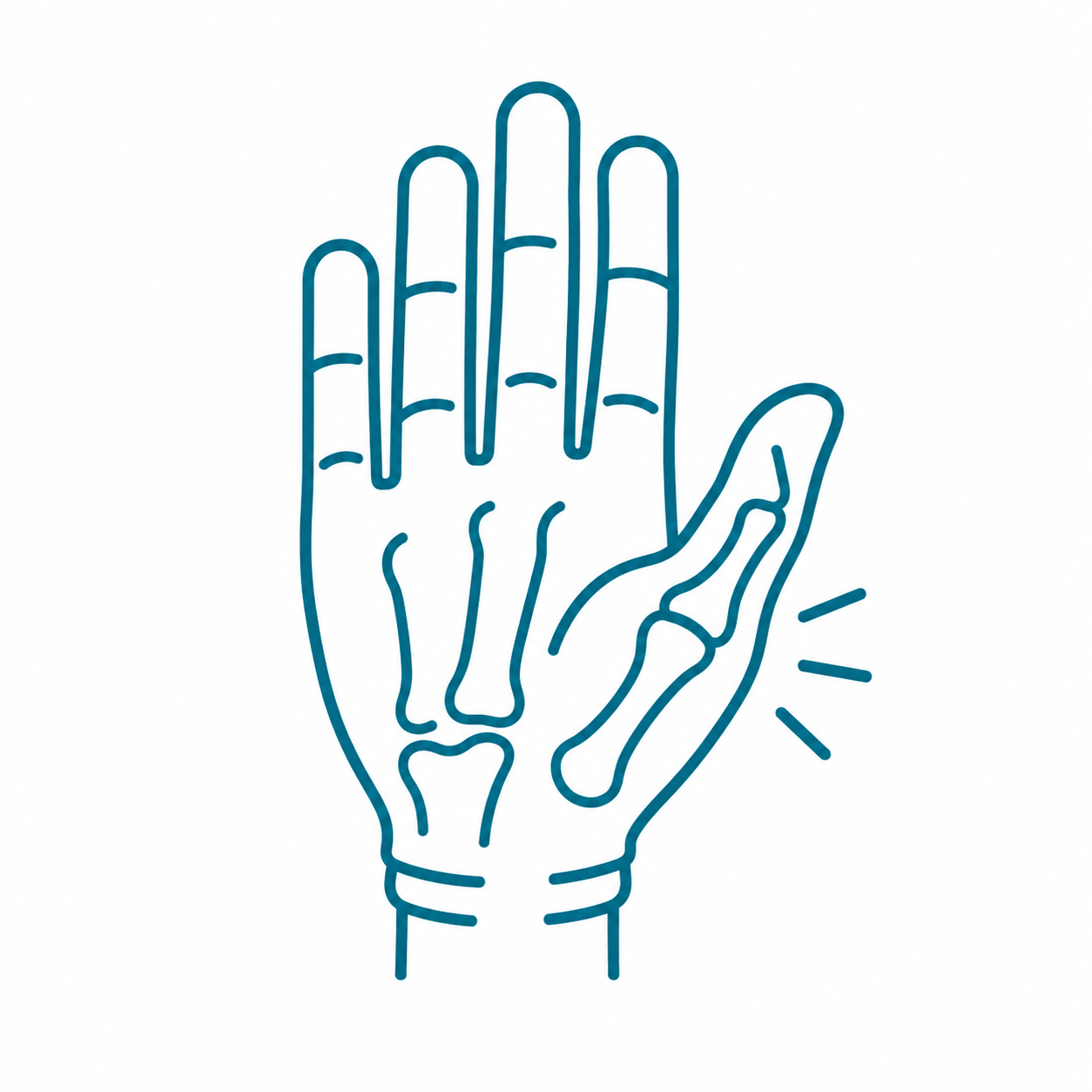 Line drawing of a human hand with an indication of a finger injury, as shown by the lines highlighting the pinky finger.