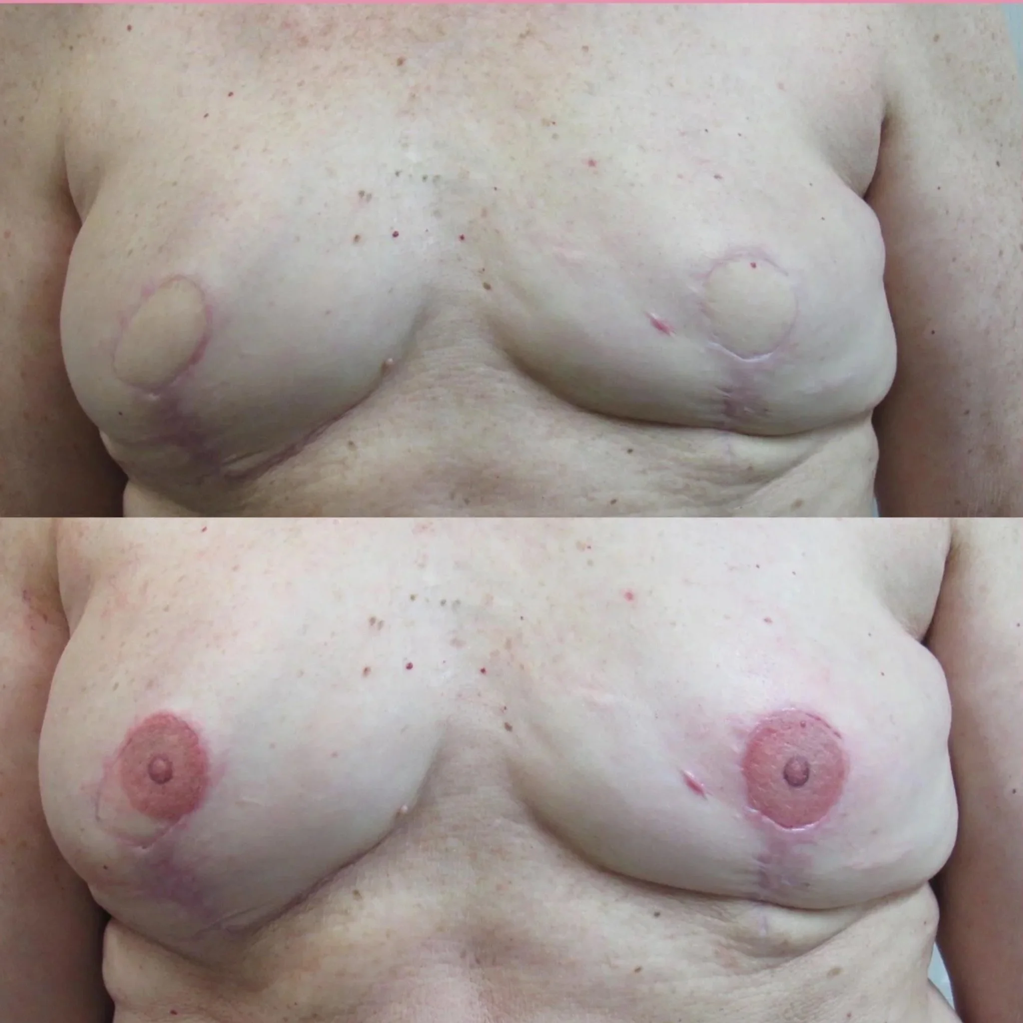 Bilateral Nipple and Areola Tattooing by Anna