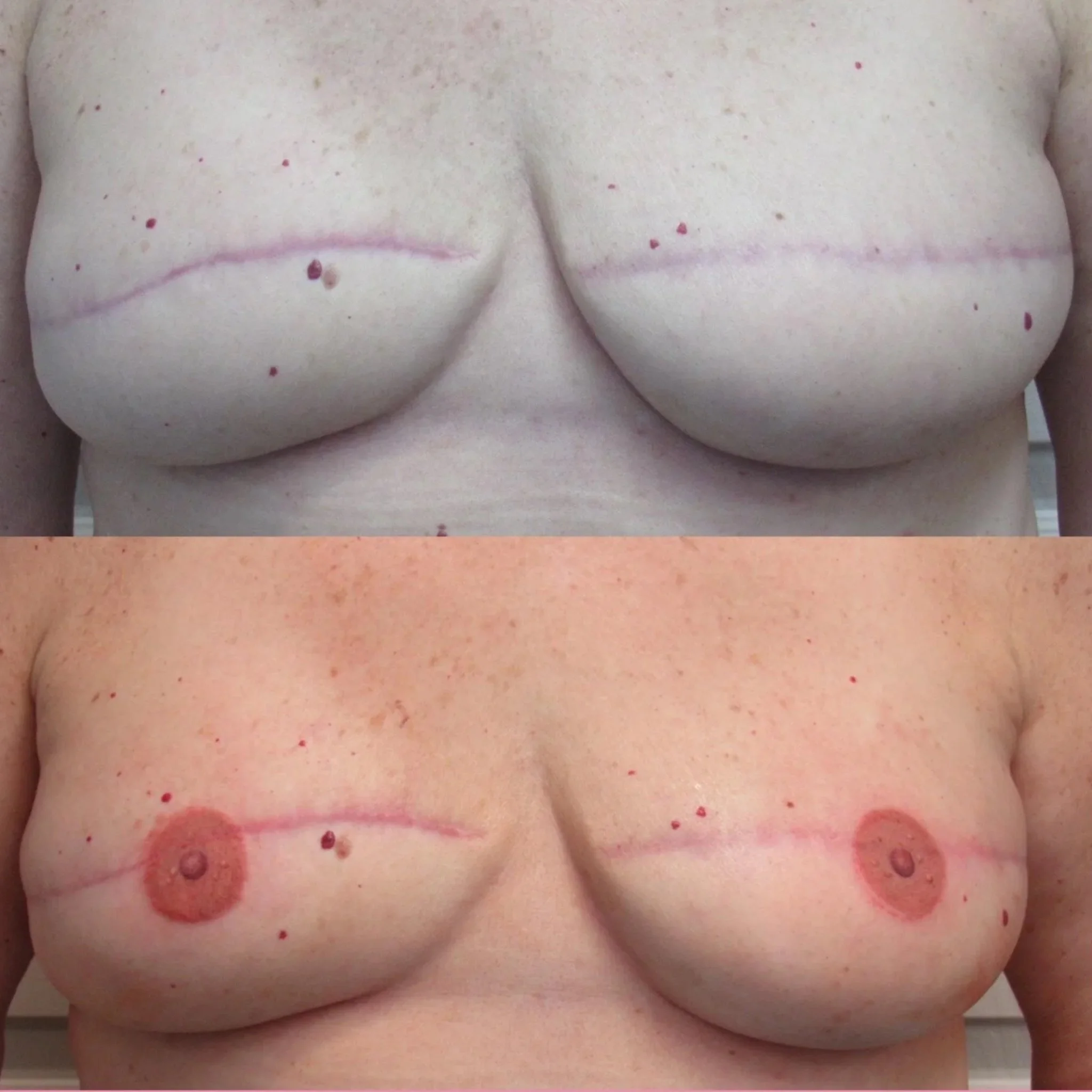 Bilateral Nipple and Areola Tattooing by Anna