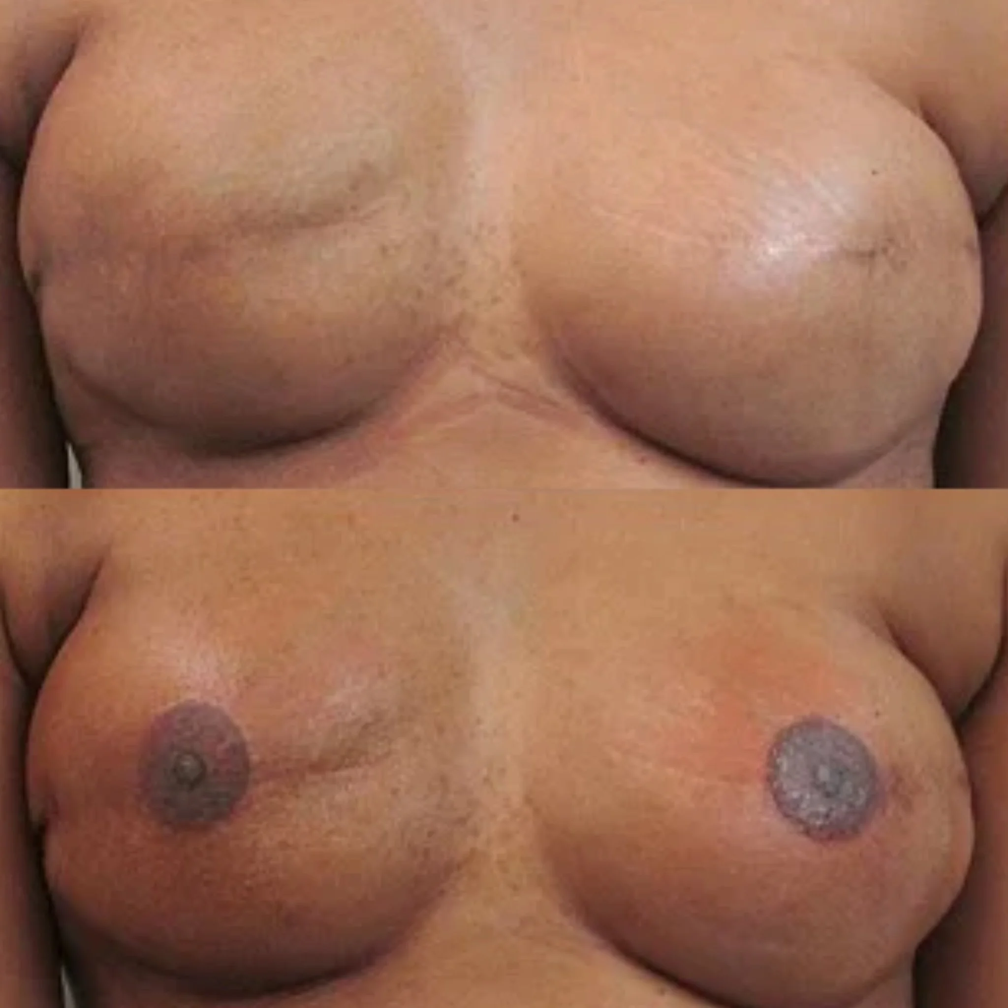 Bilateral Nipple and Areola Tattooing by Vinnie