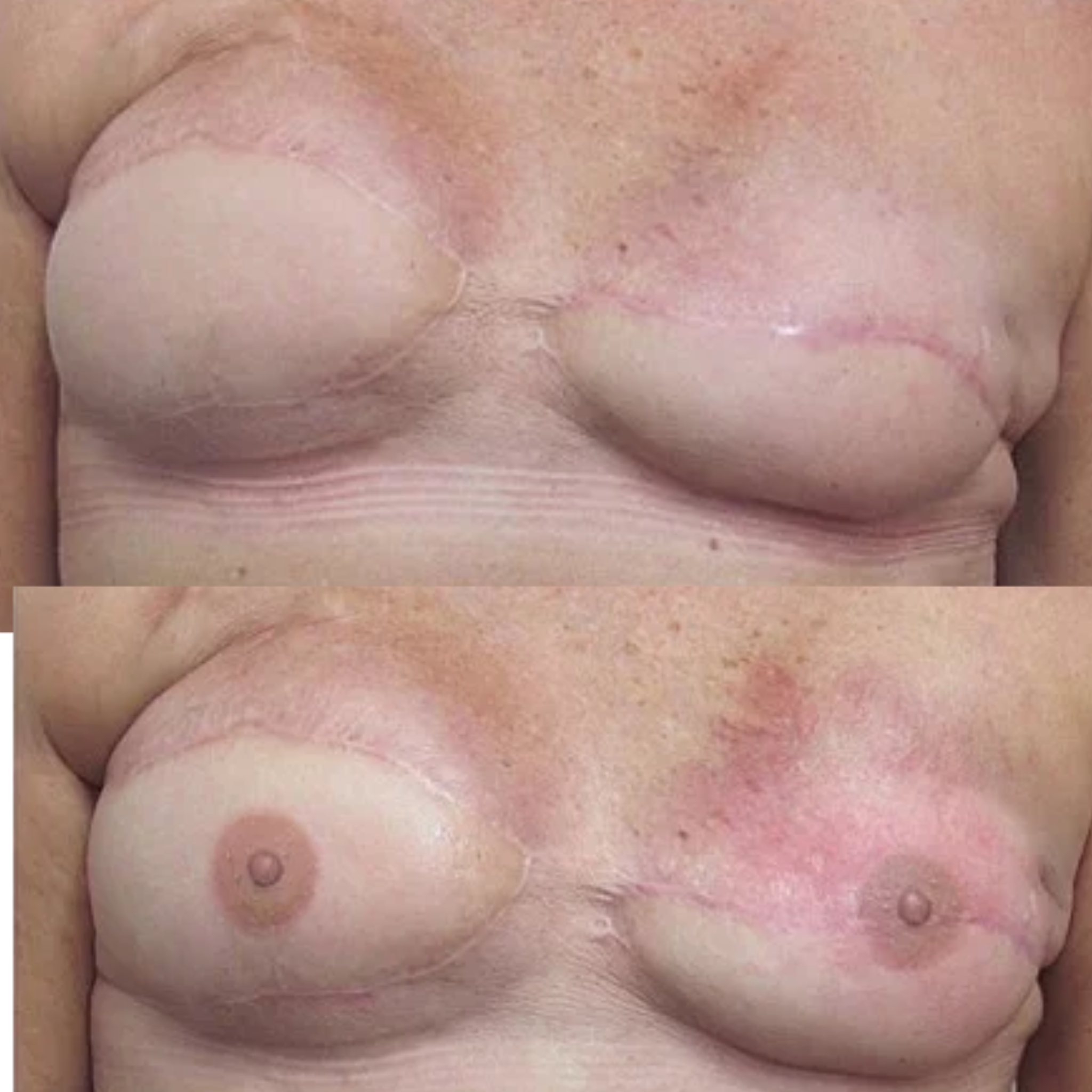 Bilateral Nipple and Areola Tattooing by Vinnie