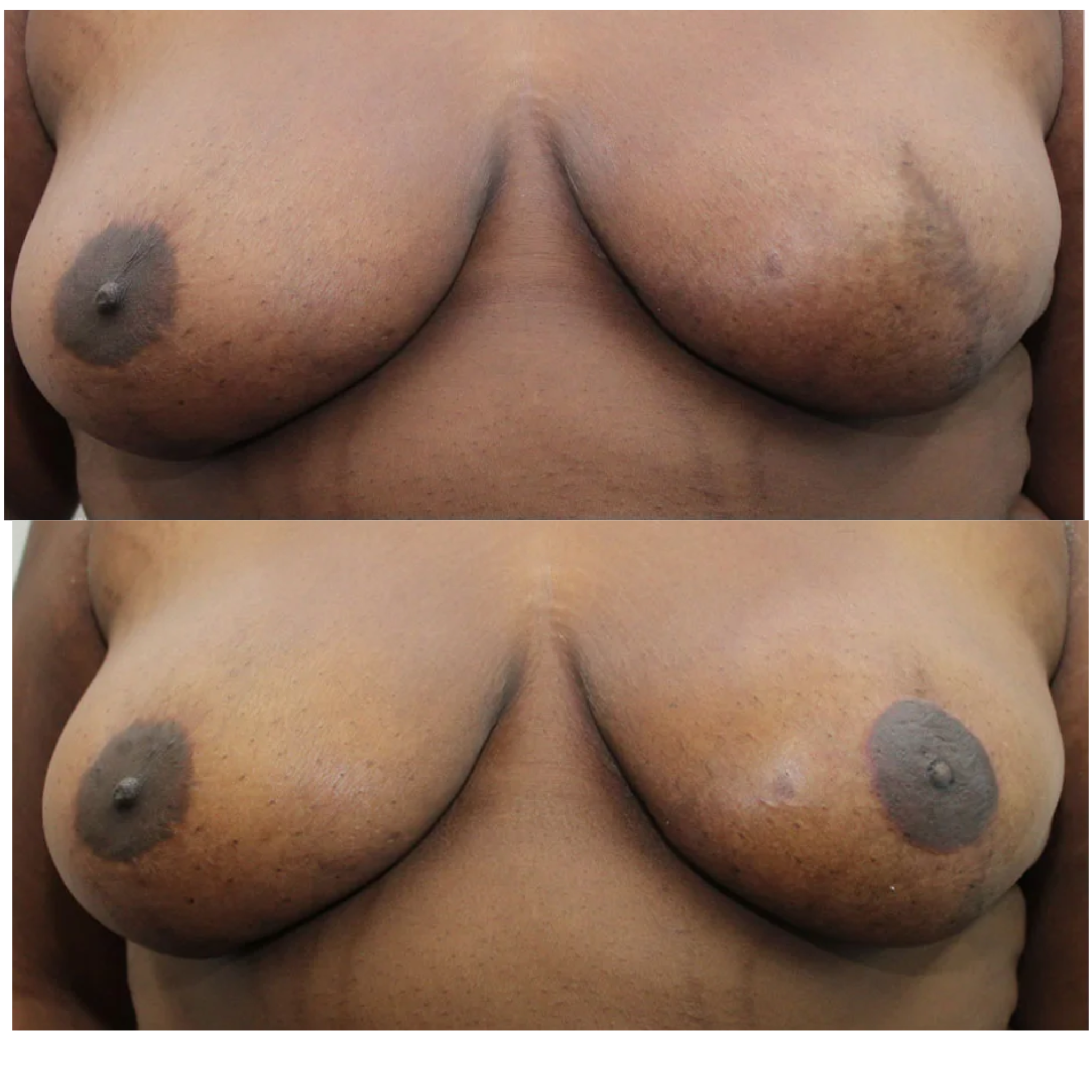 Unilateral Nipple and Areola Tattooing by Anna