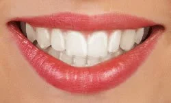 Perfect teeth after braces in Duncanville, TX