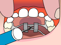 Braces treatment in Duncanville, TX