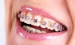Affordable braces in Duncanville, TX