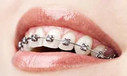 Affordable braces in Cedar Hill, TX