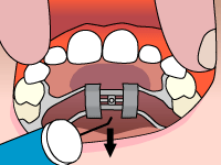 Braces in Duncanville, TX