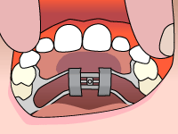 Expander in Duncanville, TX