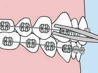 Brackets en Duncanville, TX