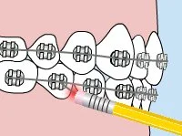 Brackets asequibles en Duncanville, TX