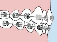 Fast braces in Duncanville, TX