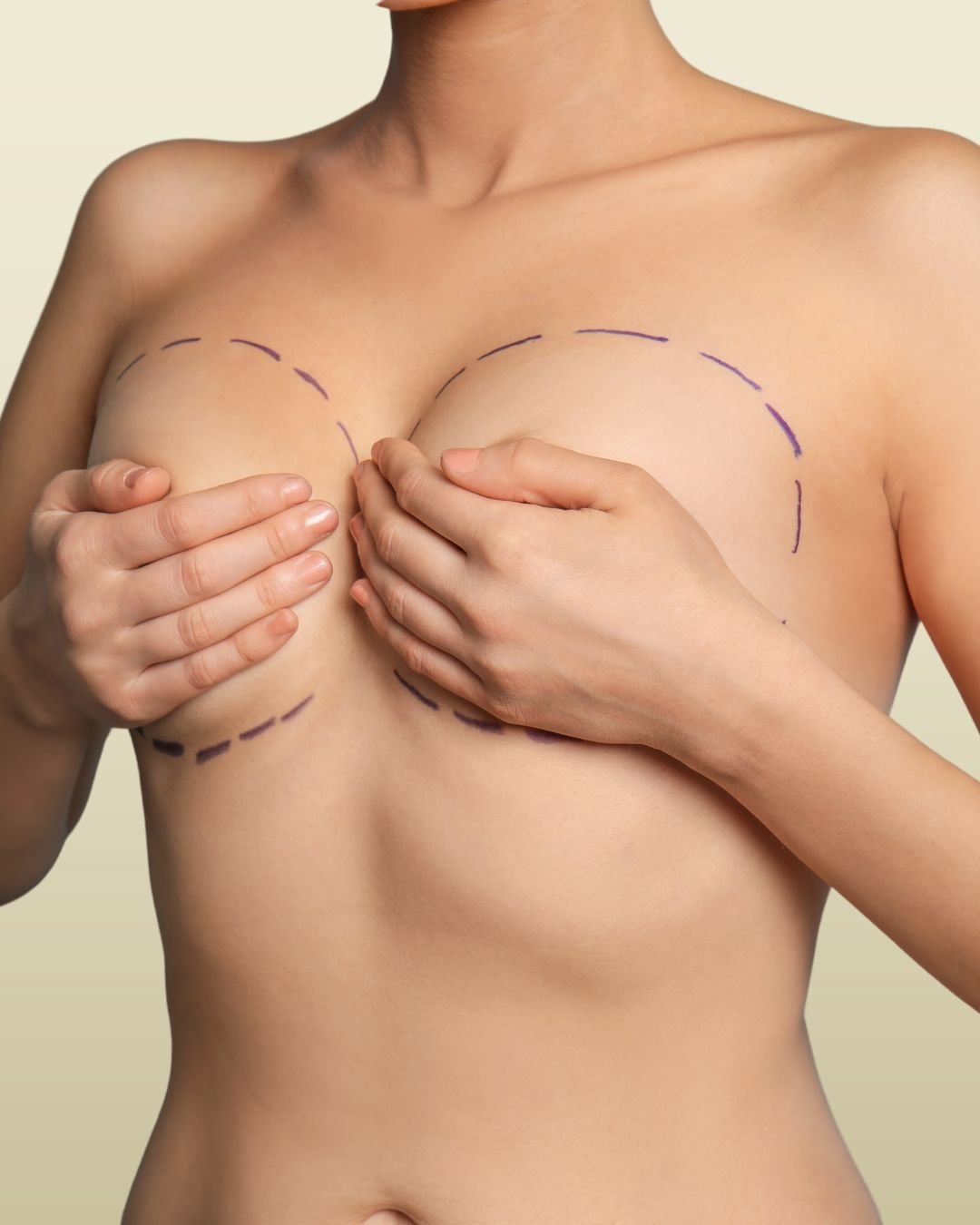 Breast Augmentation