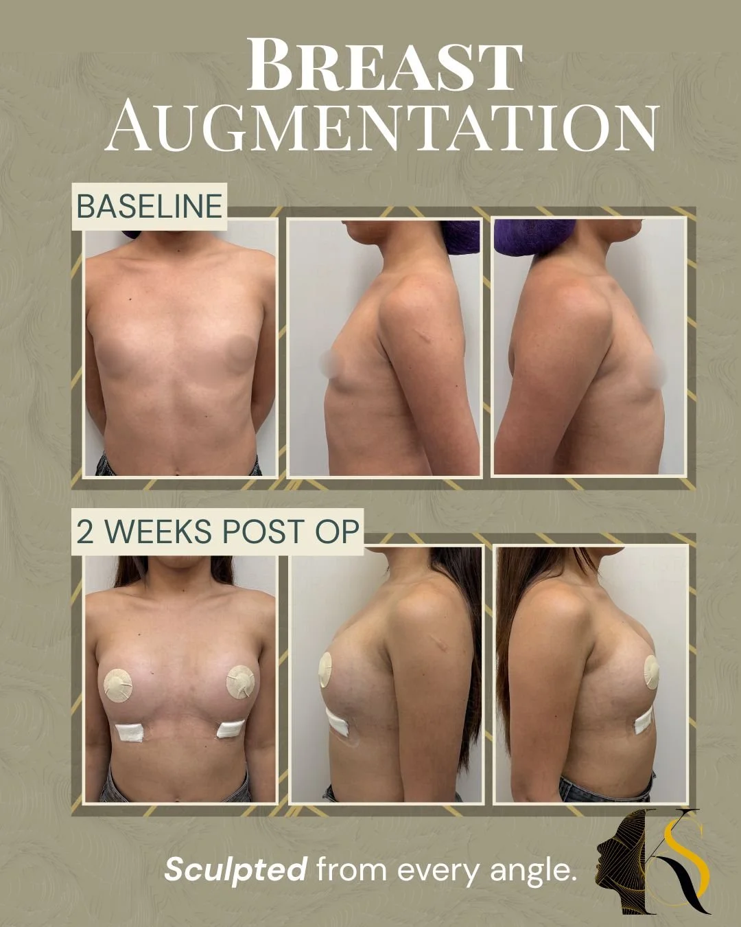 Every procedure is carefully planned according to the patient’s anatomy, frame, and desired outcome. Implant size, profile, and proportions are selected to create results that feel balanced and aligned with the patient’s vision.

Whether the goal is 
