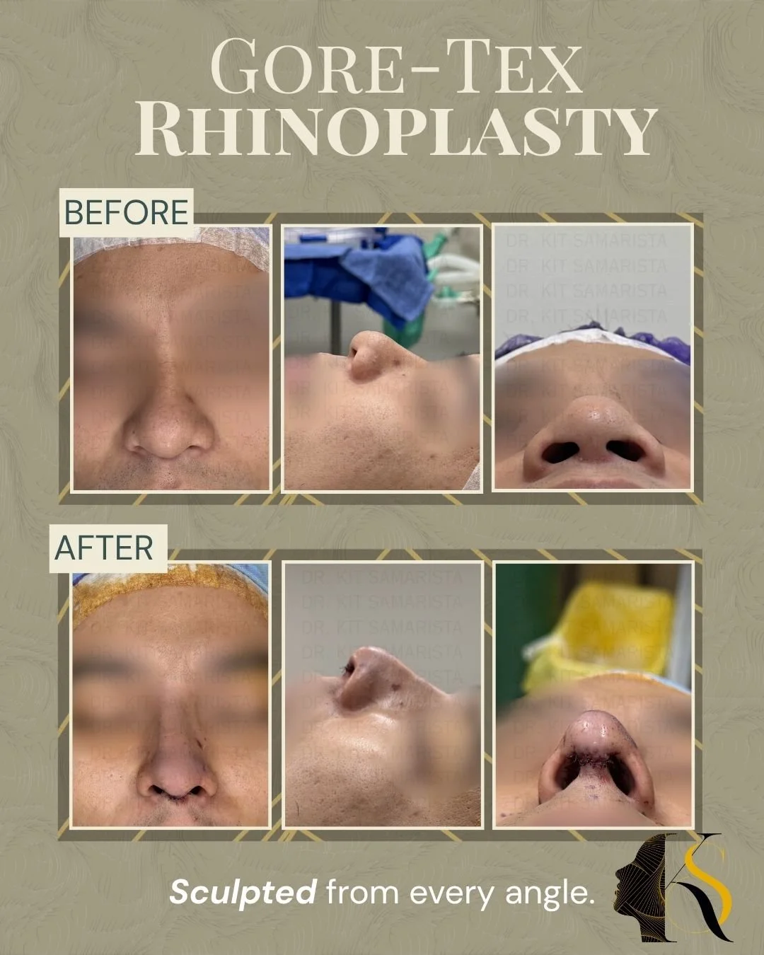 Designed for patients who want refined definition with a softer, more natural feel, Goretex Rhinoplasty offers a balanced approach to nasal enhancement.

Goretex material allows for better tissue integration and smooth contouring, making it a preferr