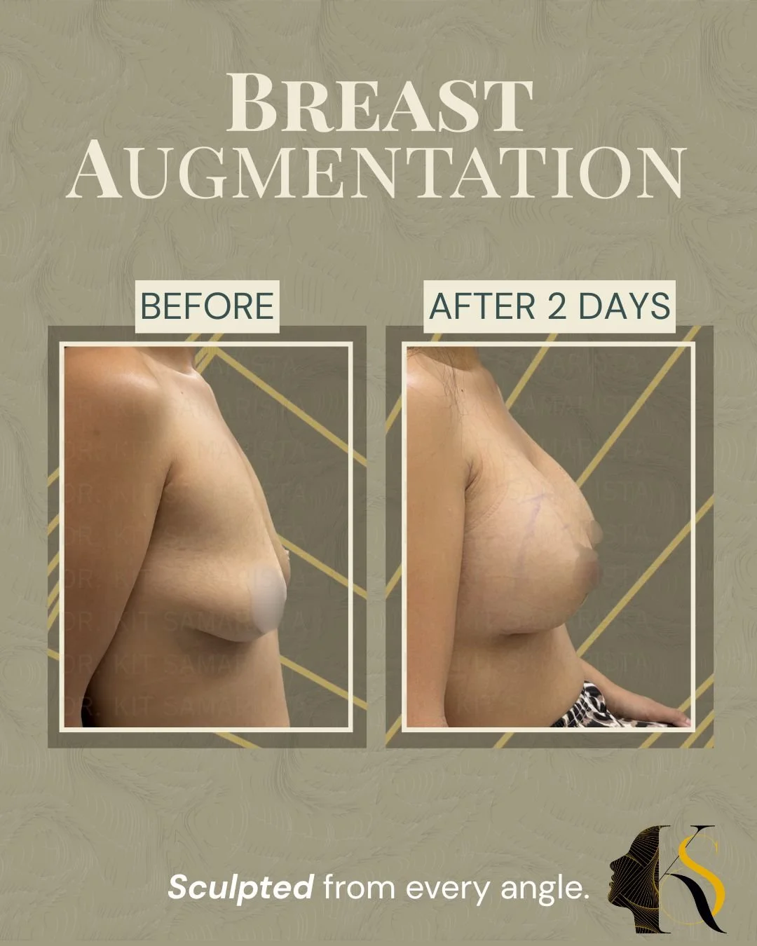 Every procedure is carefully planned according to the patient’s anatomy, frame, and desired outcome. Implant size, profile, and proportions are selected to create results that feel balanced and aligned with the patient’s vision.

Whether the goal is 