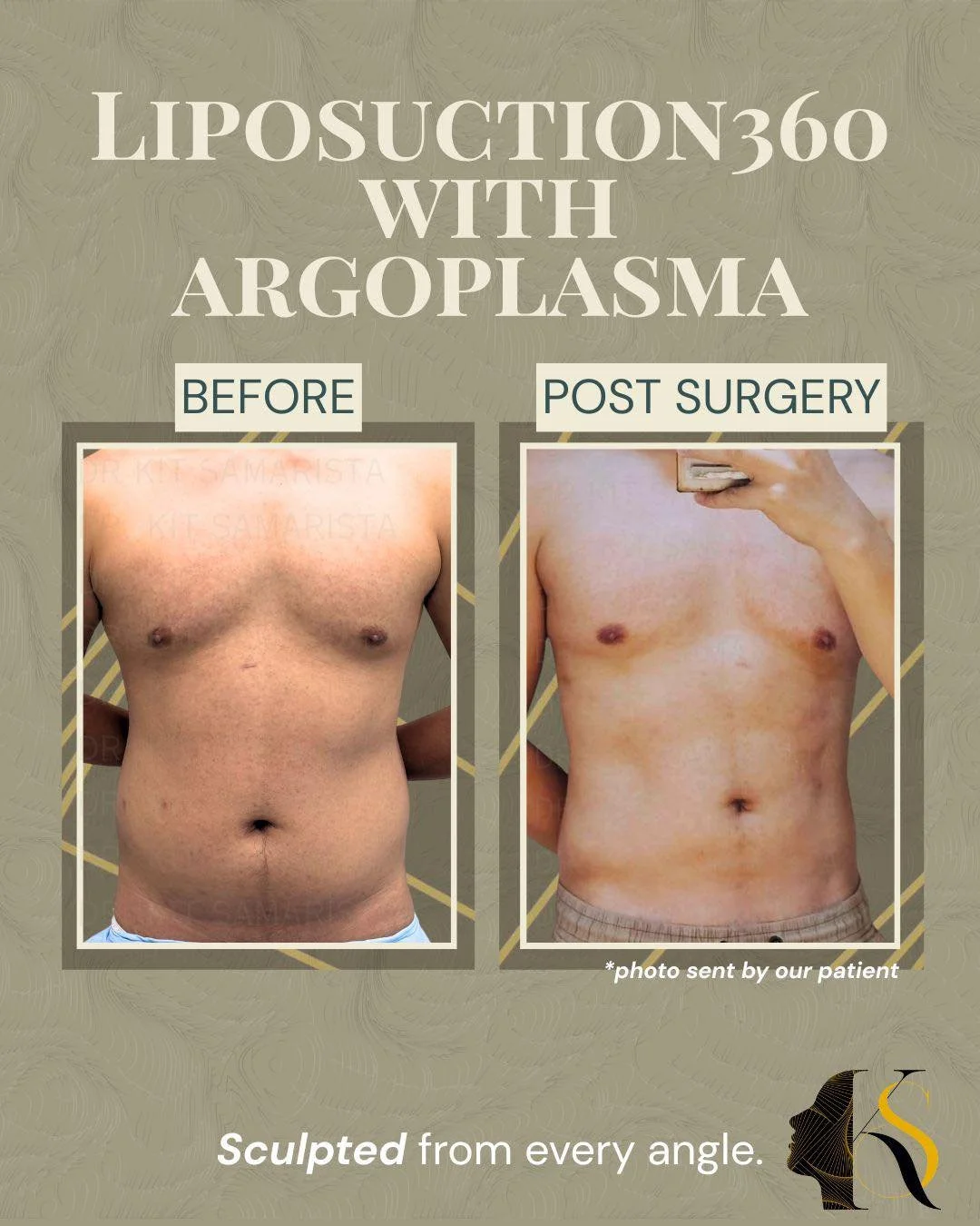 Liposuction360 with Argoplasma | 4 Months Post-Op

The best results happen when precision surgery meets a healthy lifestyle.

At 4 months after Liposuction360 with Argoplasma, this patient shows a leaner waistline, improved abdominal definition, and 